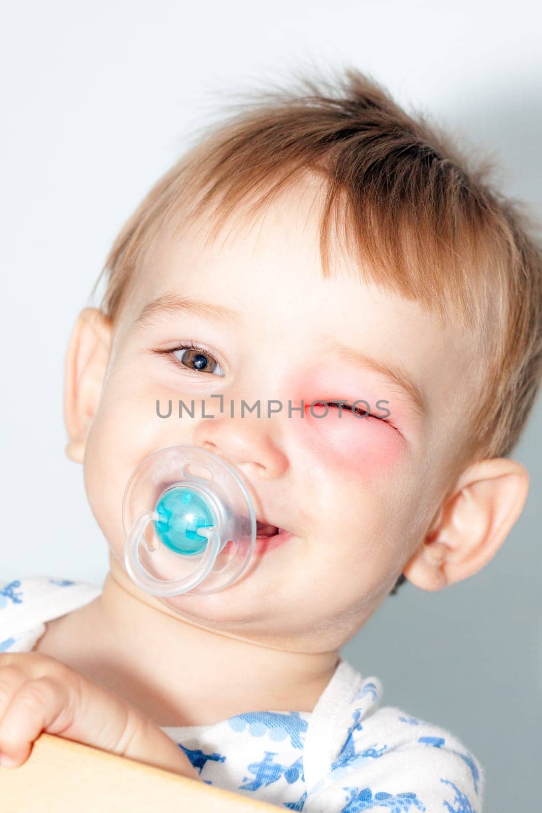 Little Boy - Dangerous Stings From Wasps Near The Eye