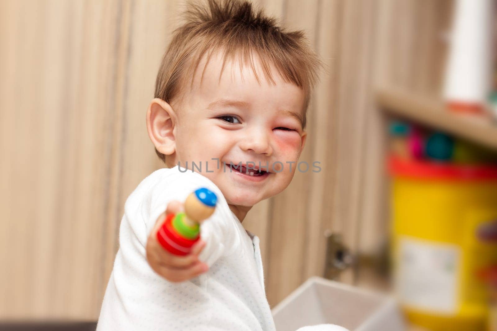 Little Boy - Dangerous Stings From Wasps Near The Eye