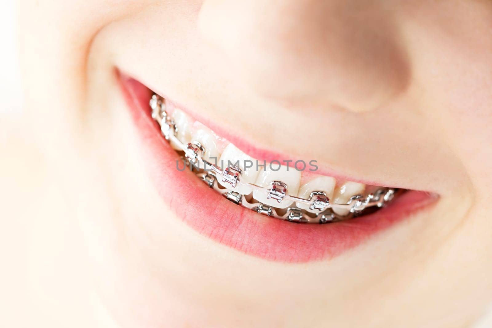 Closeup on braces and white teeth of smiling girl