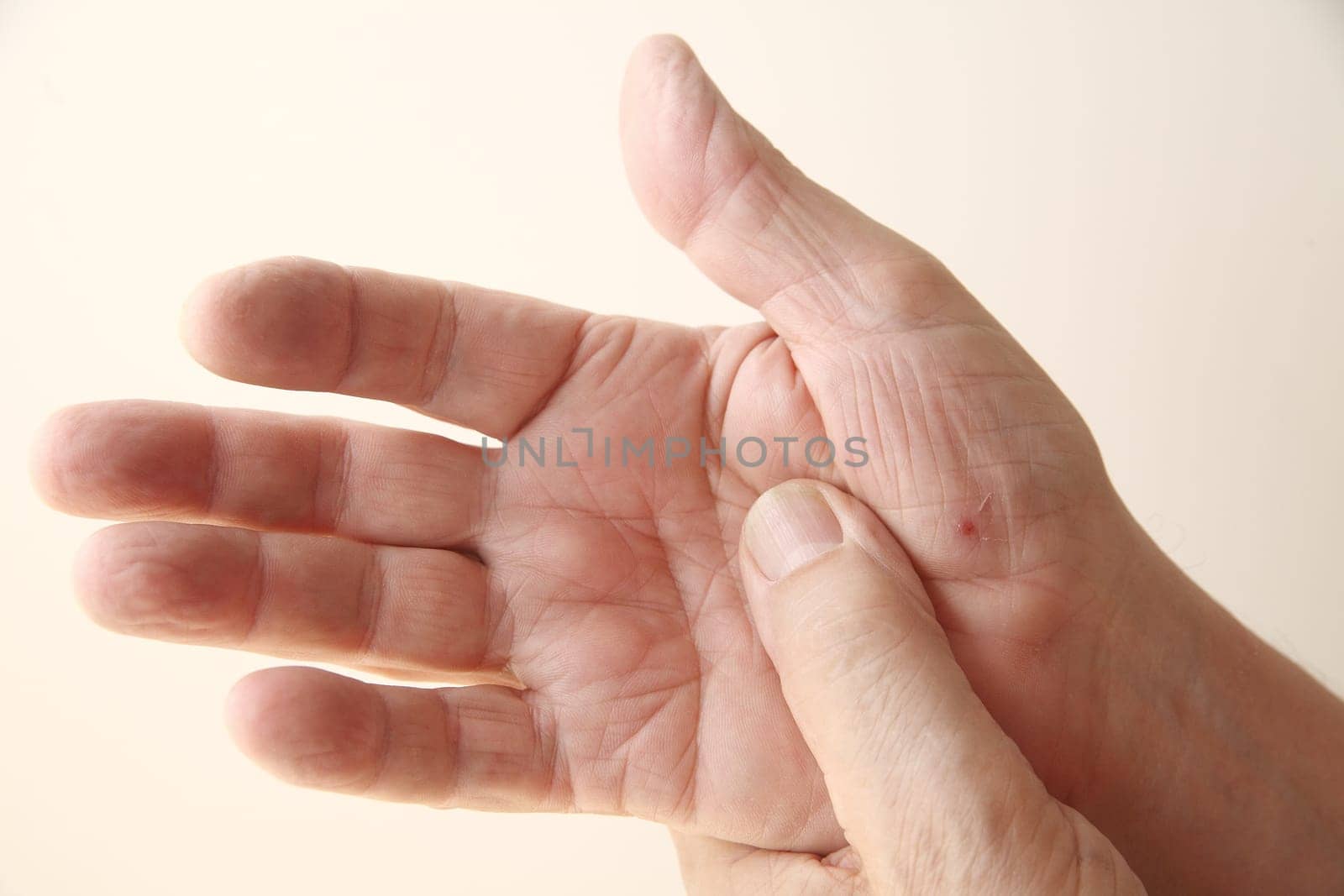 man's hand with new skin on a cut