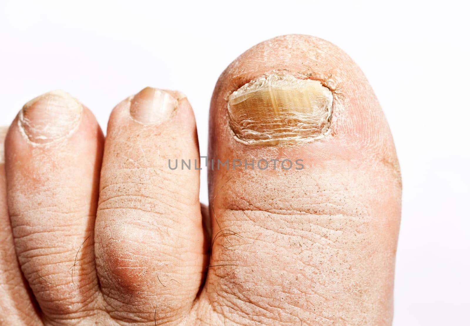 Fungus infection on nails of man's foot
