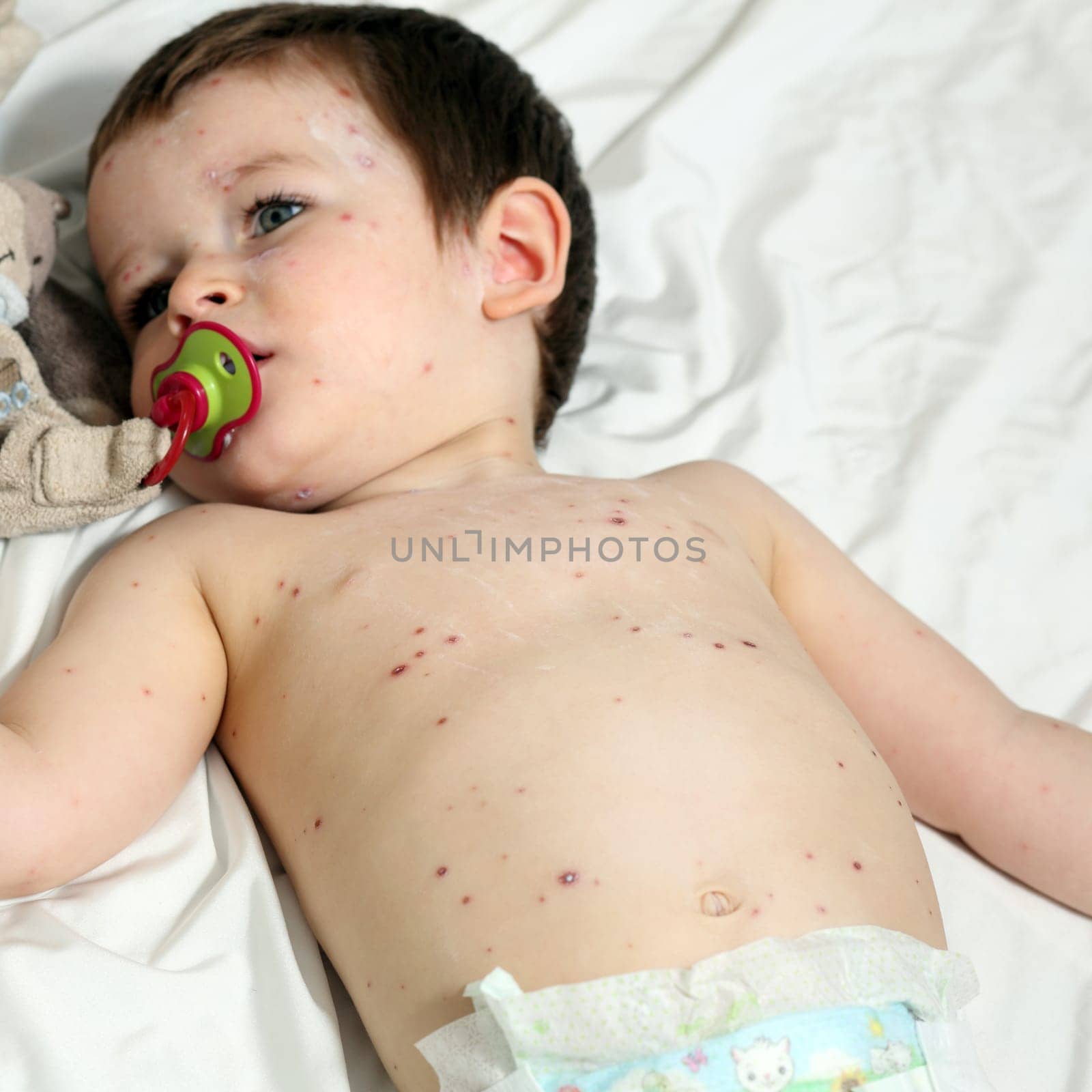 Details of a baby aged 20 months old, he has chickenpox.
