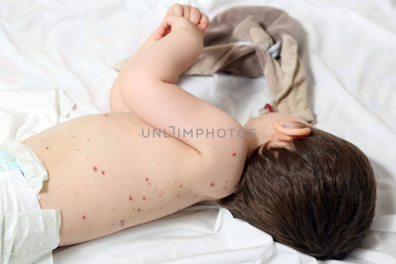 Details of a baby aged 20 months old, he has chickenpox.
