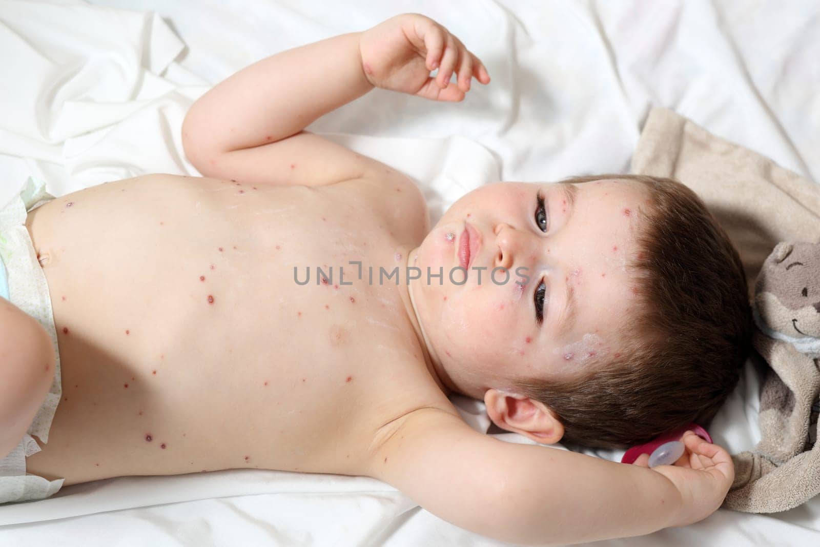 Details of a baby aged 20 months old, he has chickenpox.