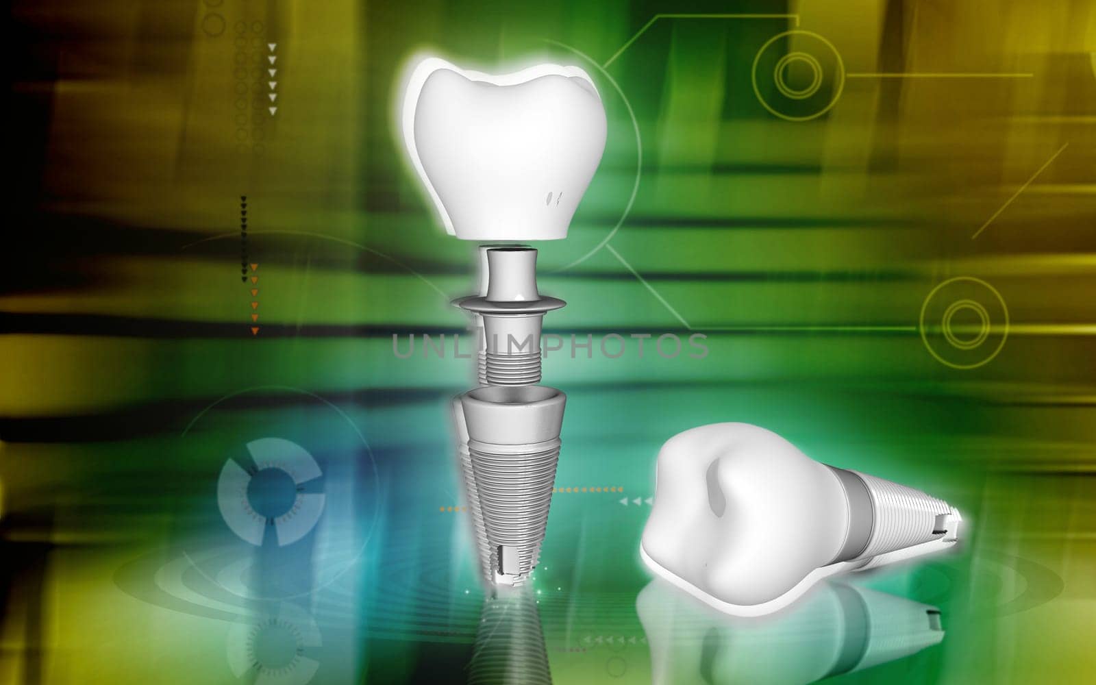 Digital illustration Dental implant in colour background
