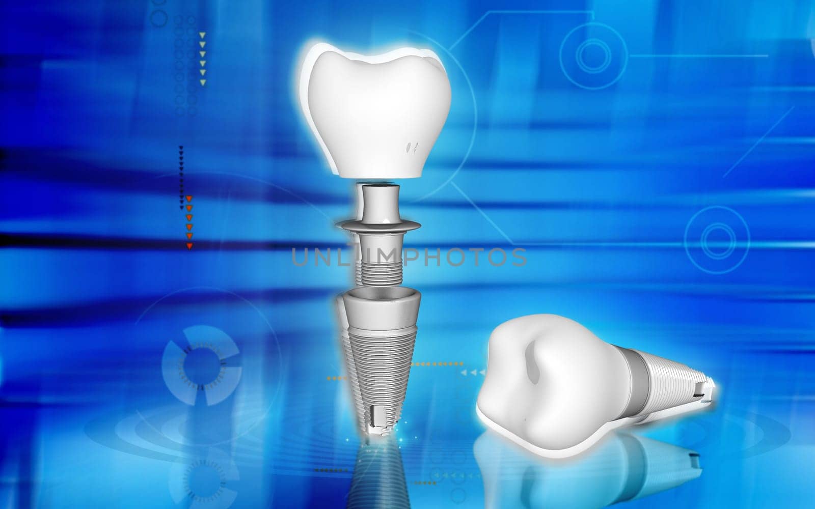Digital illustration Dental implant in colour background
