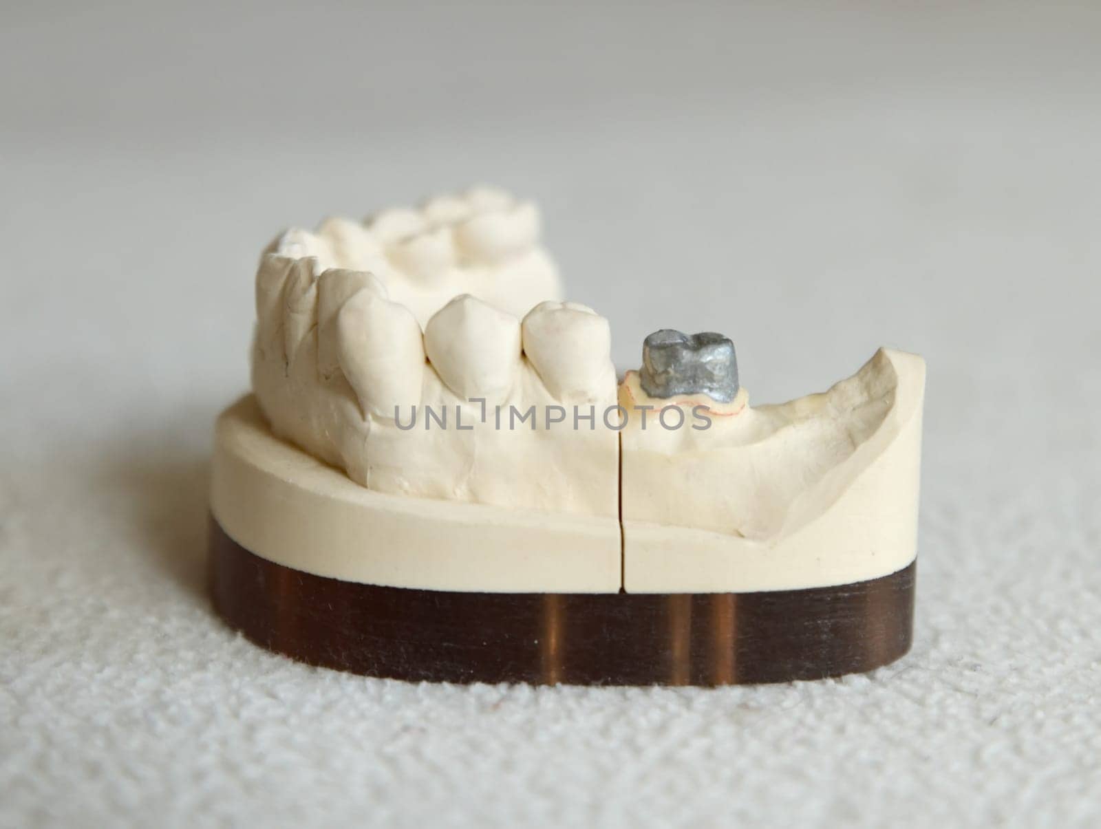 Zirconium or porcelain crown preparation on cast model