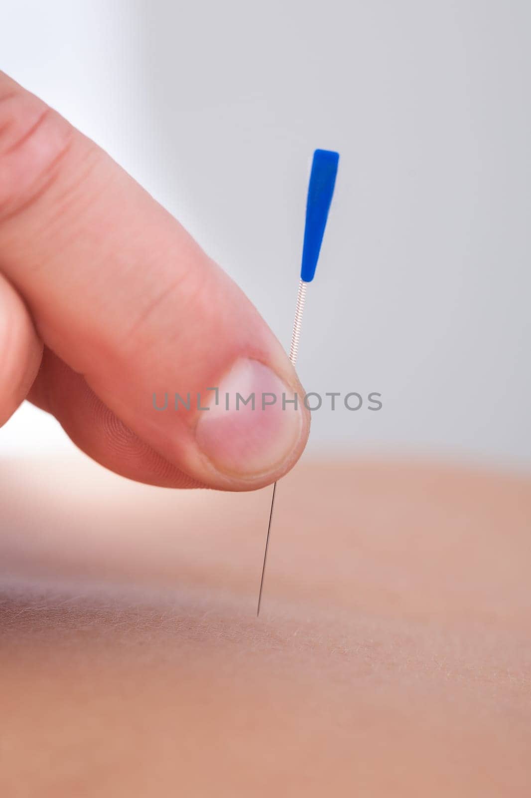 Macro Detail Of A Hand Stimulating An Acupuncture Needle On The Back Of A Patient