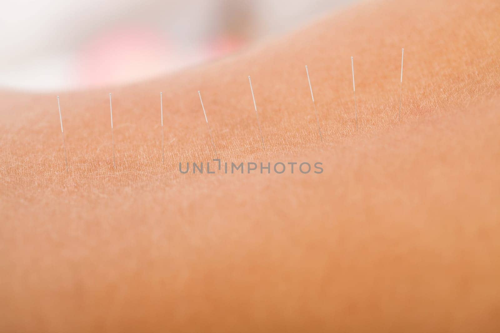 Acupuncture needle inserted by experienced professional only.