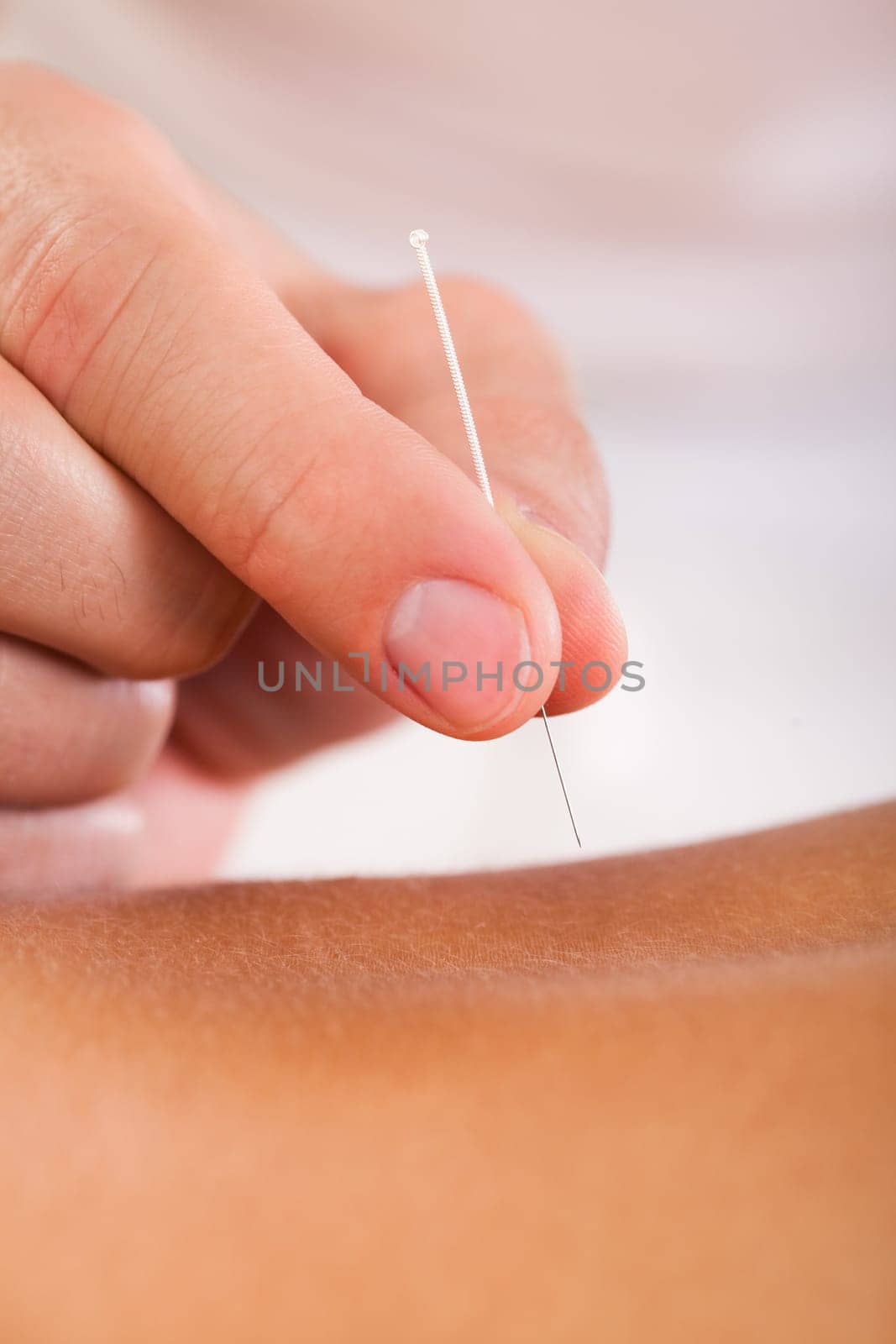 Acupuncture needle inserted by experienced professional only.