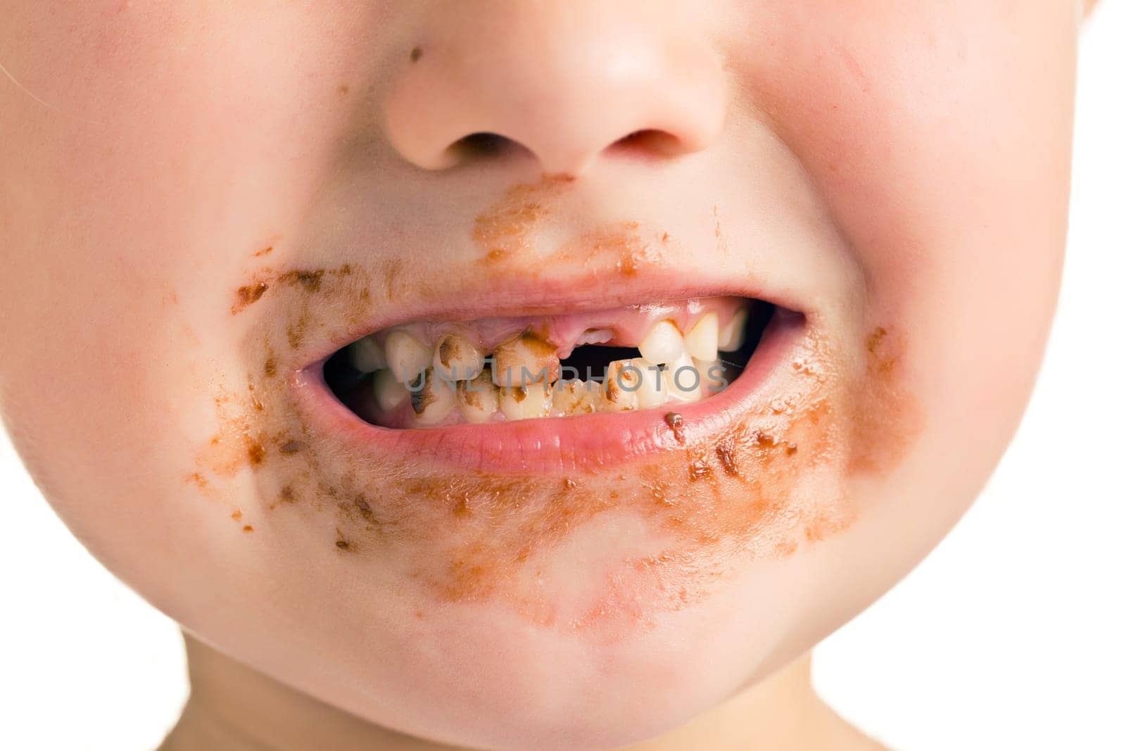the child with a dirty mouth and missing tooth