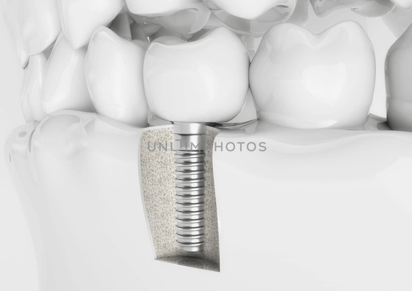 Dental implant with crown in a denture model