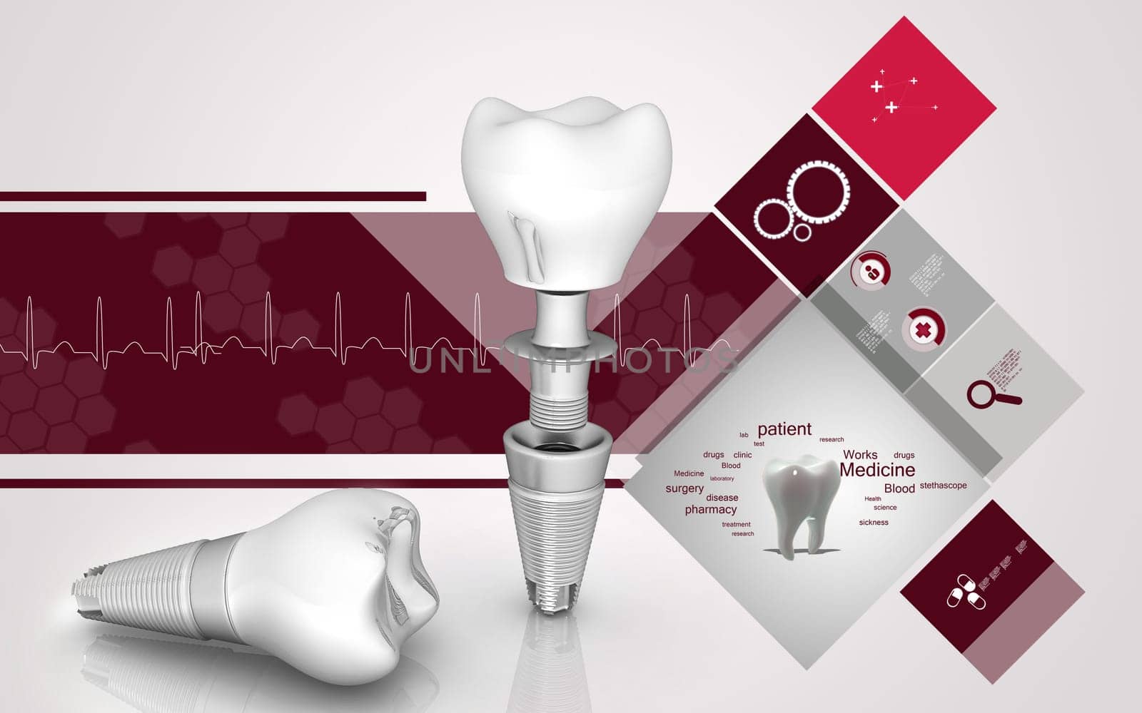 Dental implant