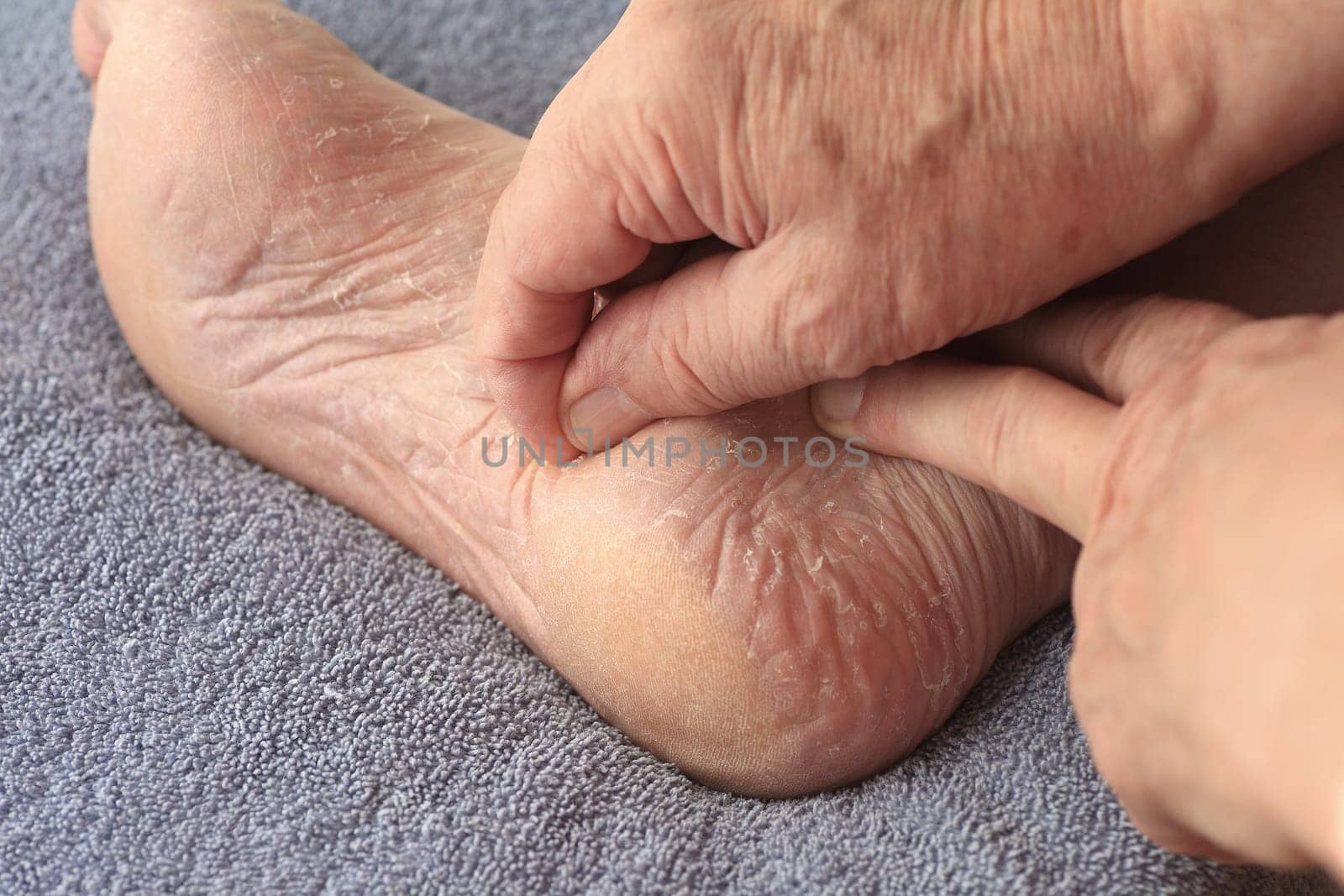 A man peeling his athletes foot dry skin