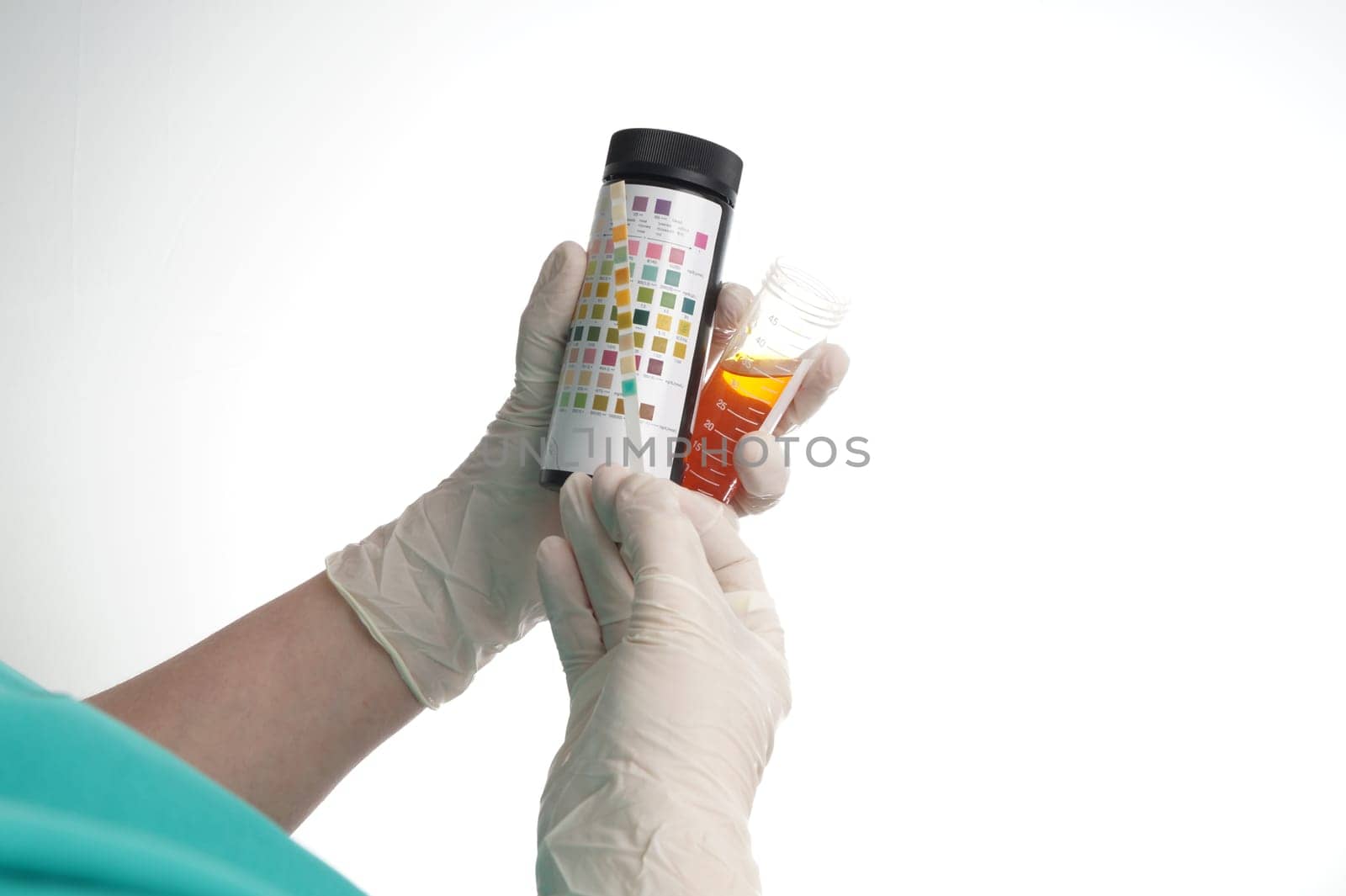 Urine test stripes examined by a nurse. Lab sample