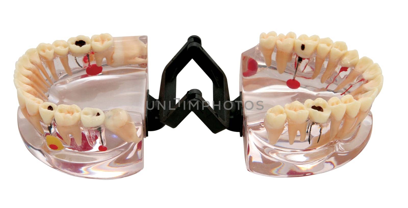 Dentist denture model with teeth and cavities isolated on white background