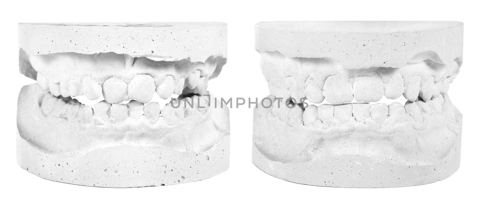Plaster prints before and after treatment