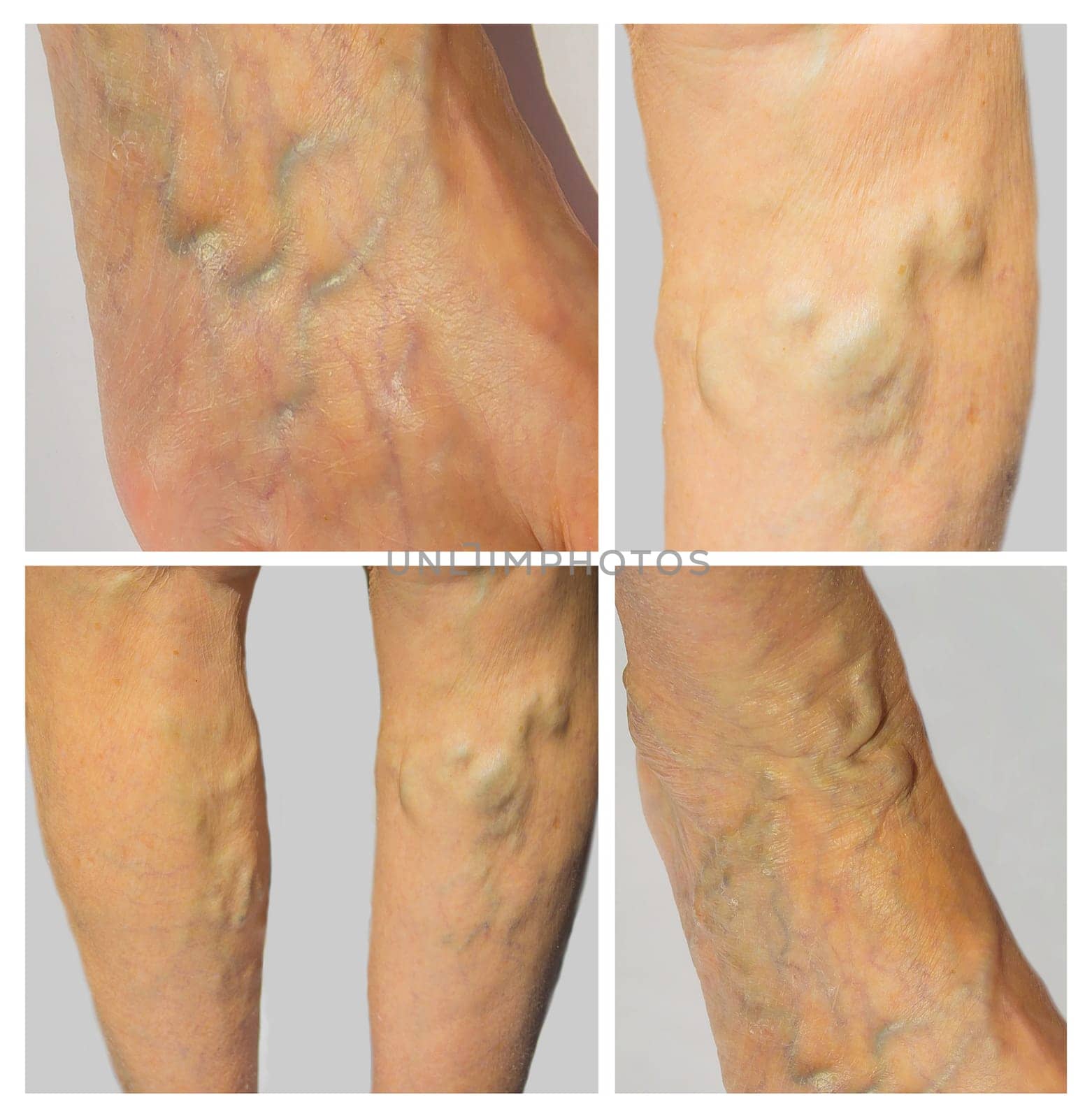 The varicose veins on a legs of old woman on gray