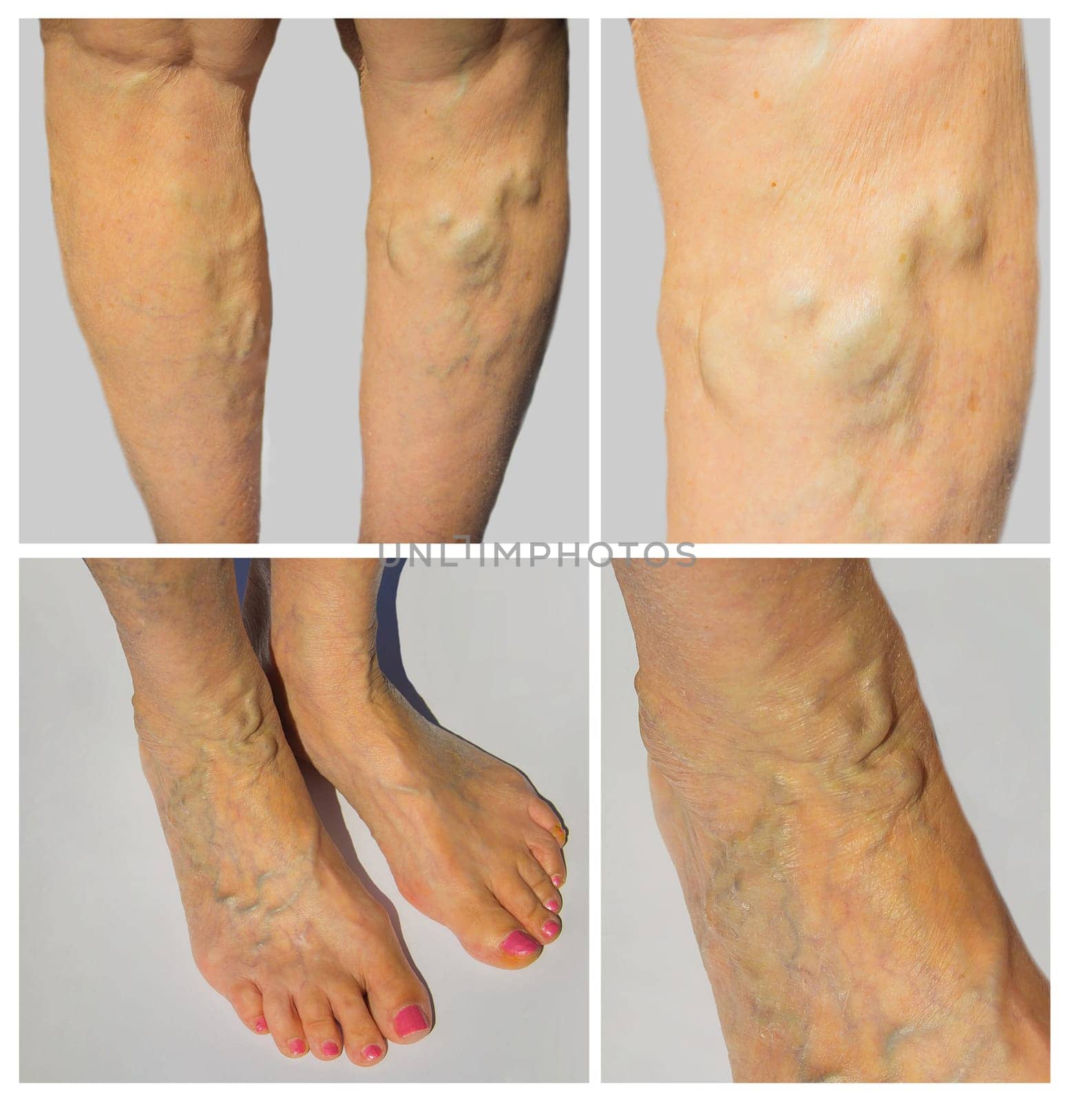 The varicose veins on a legs of old woman on gray