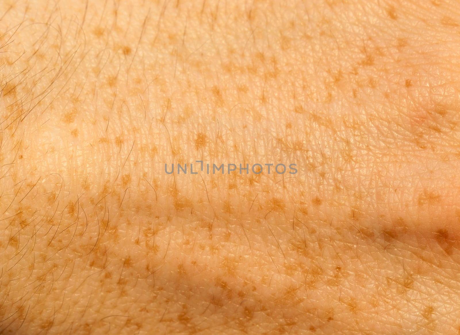 photographed close-up part of a man's hand, covered with orange freckles