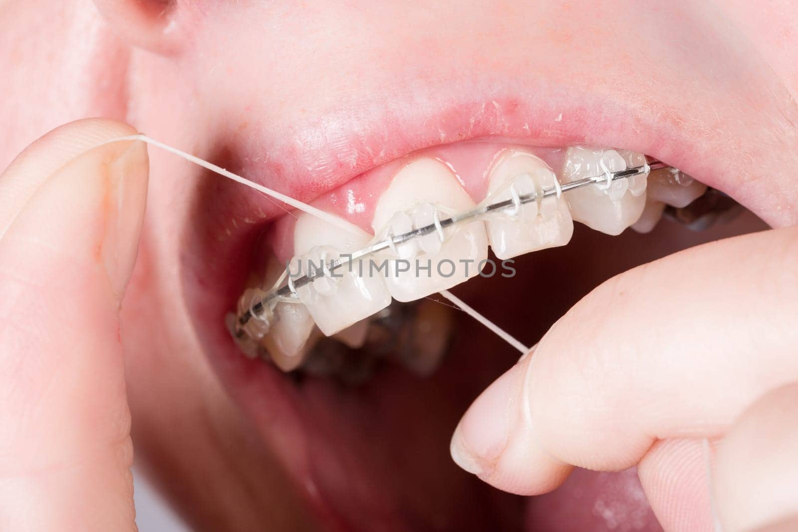 Mouth with tooth clip