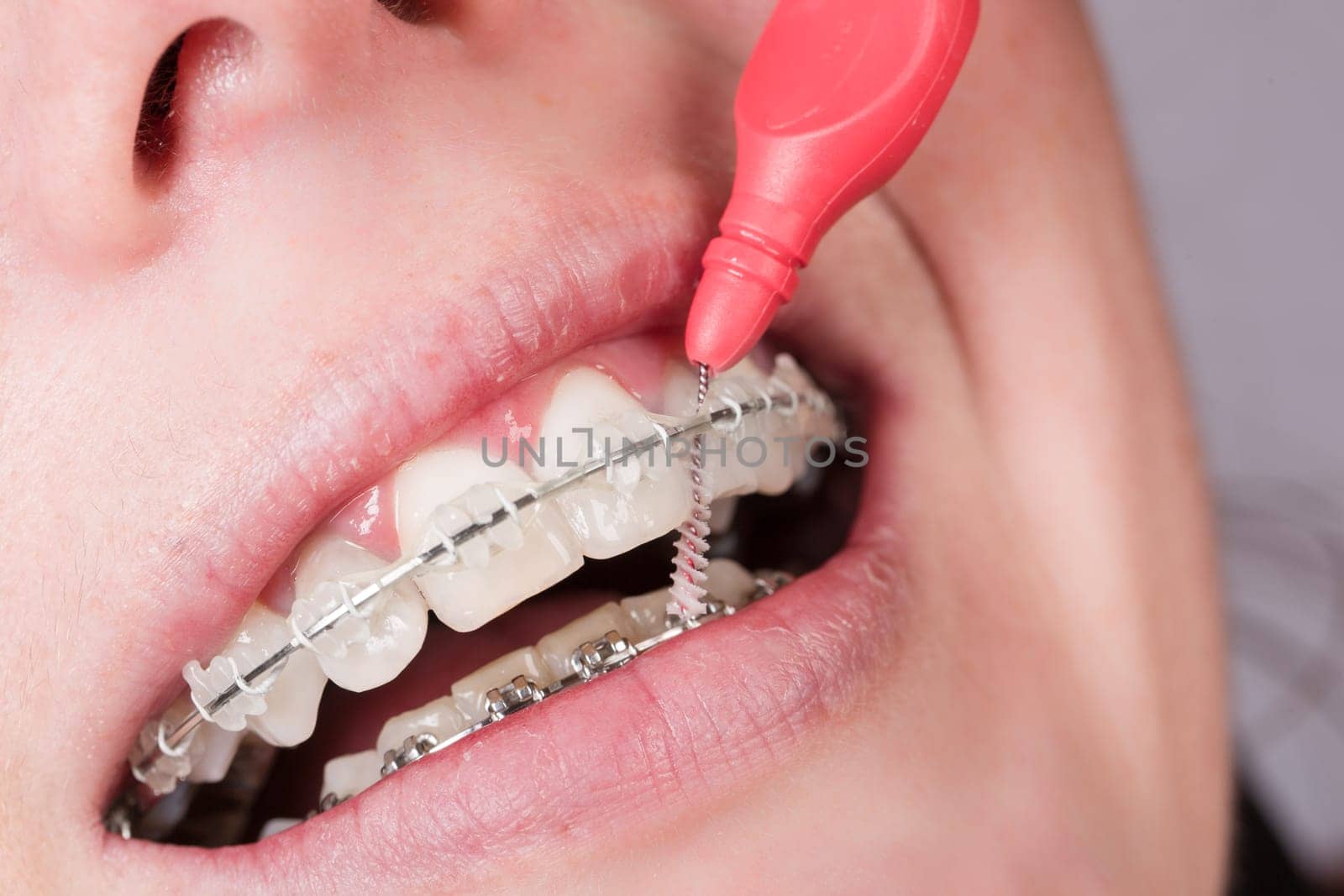Mouth with tooth clip is cleaned with floss