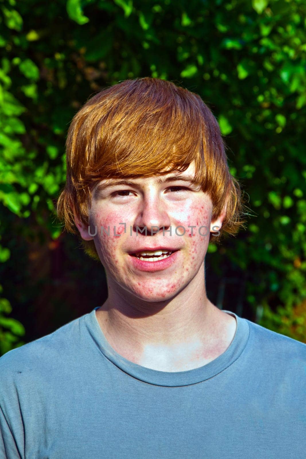 portrait of cute boy in puberty with acne