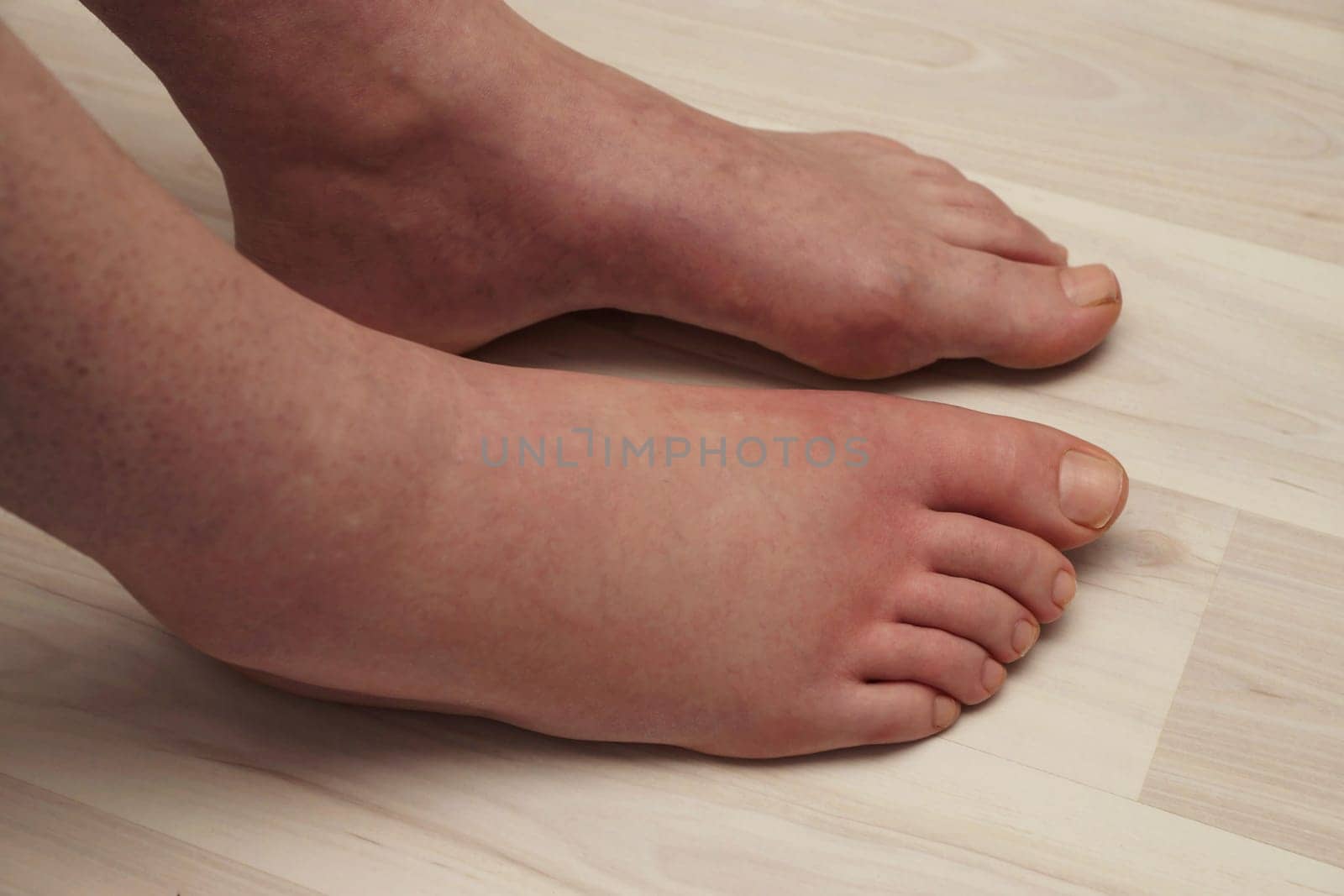Painful allergic reaction on the foot due to a wasp sting
