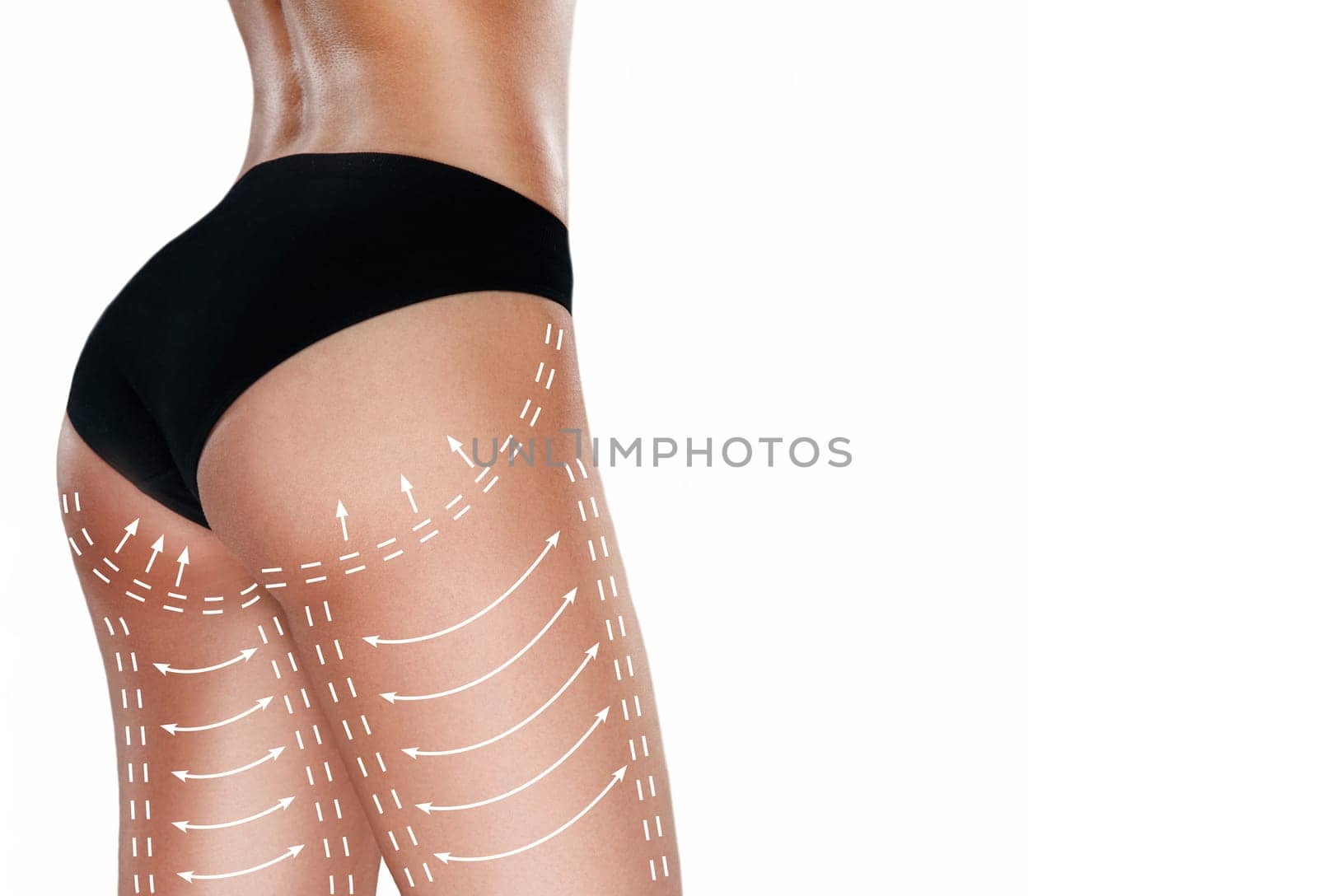Marks on the women's buttocks, waist and legs before plastic surgery. The concept of plastic surgery
