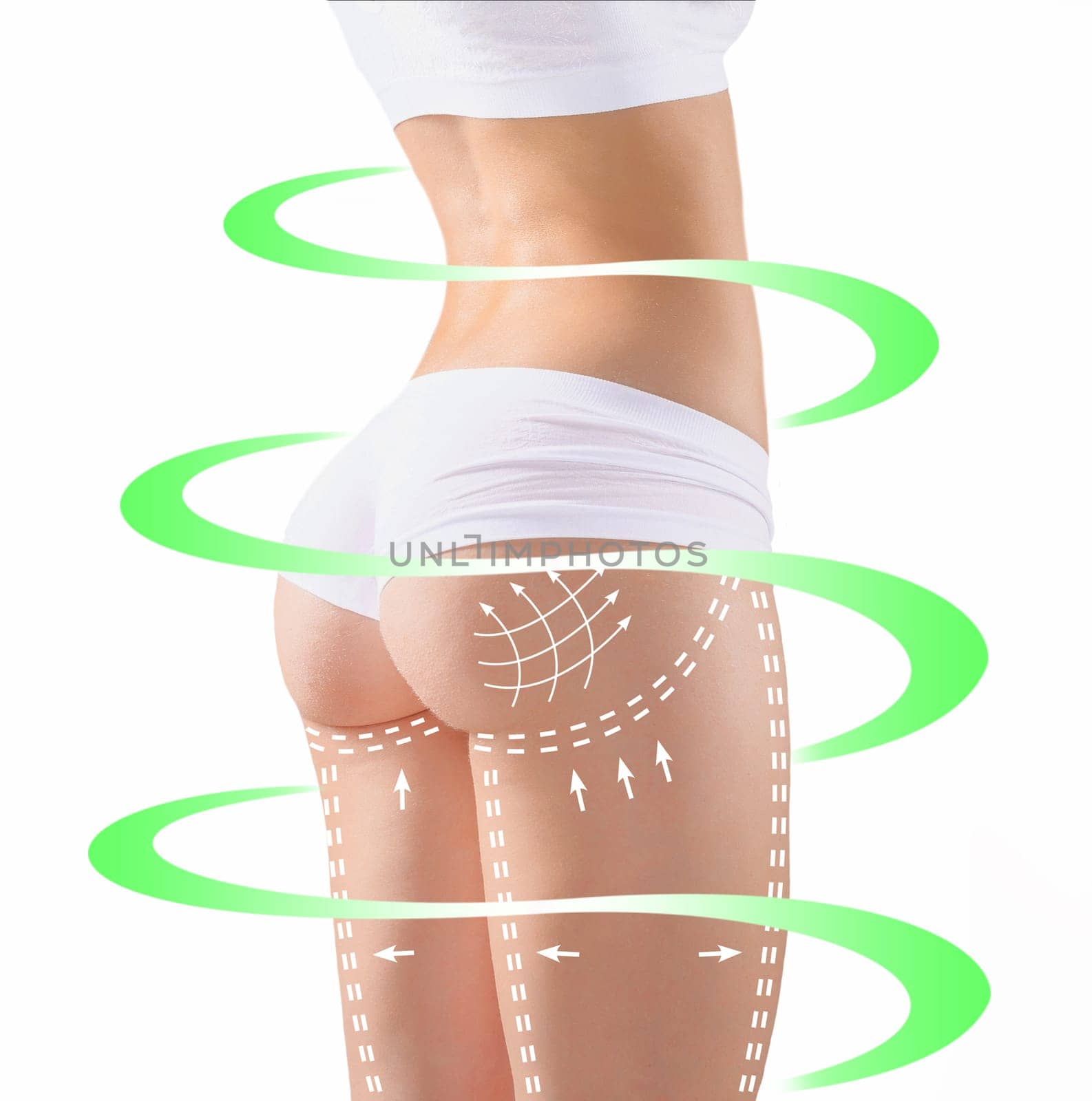 Marks on the women's buttocks, waist and legs before plastic surgery. The concept of plastic surgery