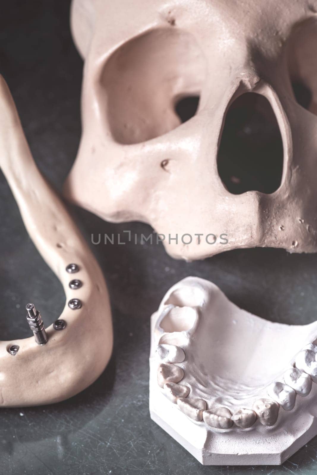 Dental prosthesis, artificial tooth. Photo of artificial teeth made in the dental laboratory.