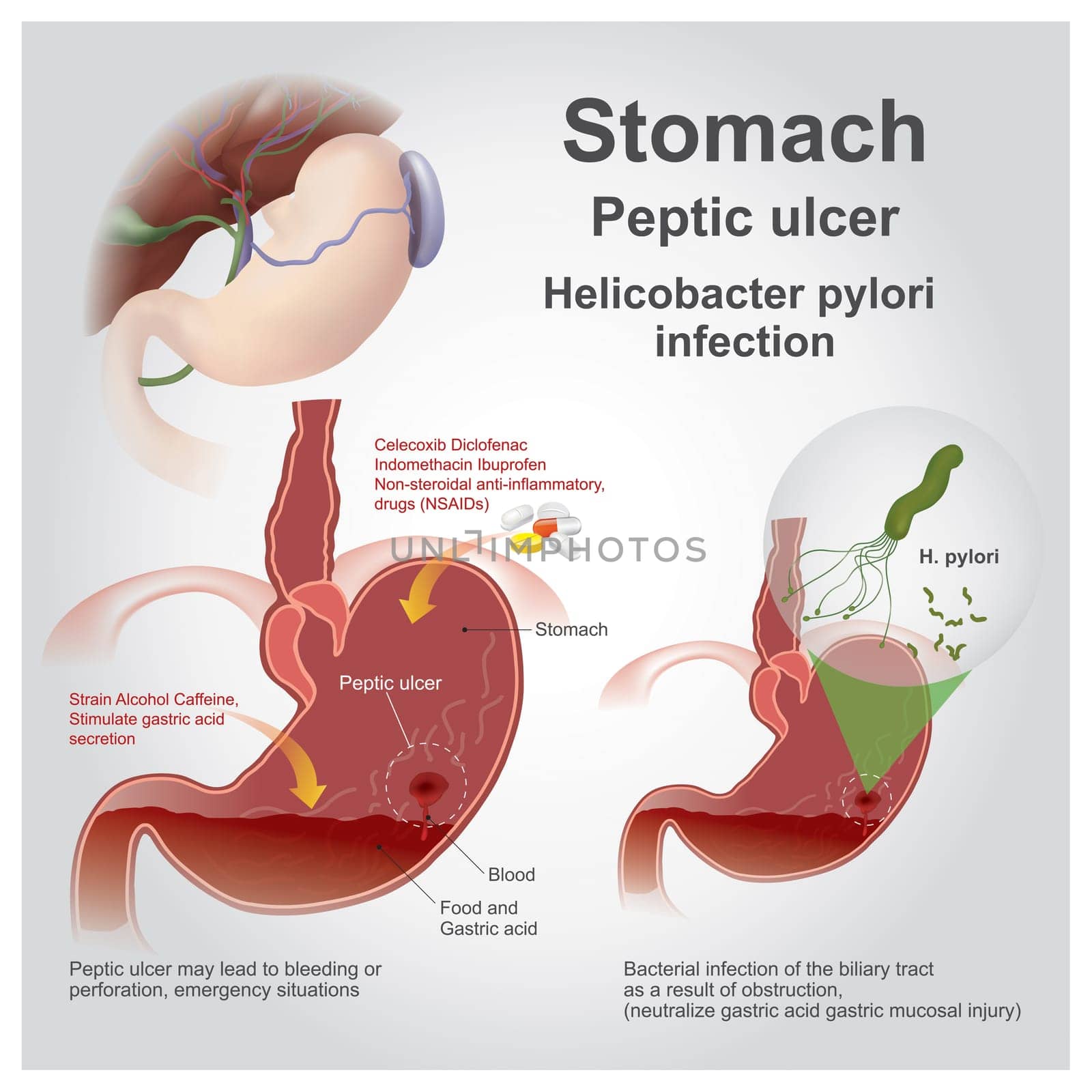 Eptic ulcer disease, also known as a peptic ulcer or stomach ulcer, is a break in the lining of the stomach, first part of the small intestine, or occasionally the lower esophagus. An ulcer in the stomach is known as a gastric ulcer while that in the first part of the intestines is known as a duodenal ulcer.