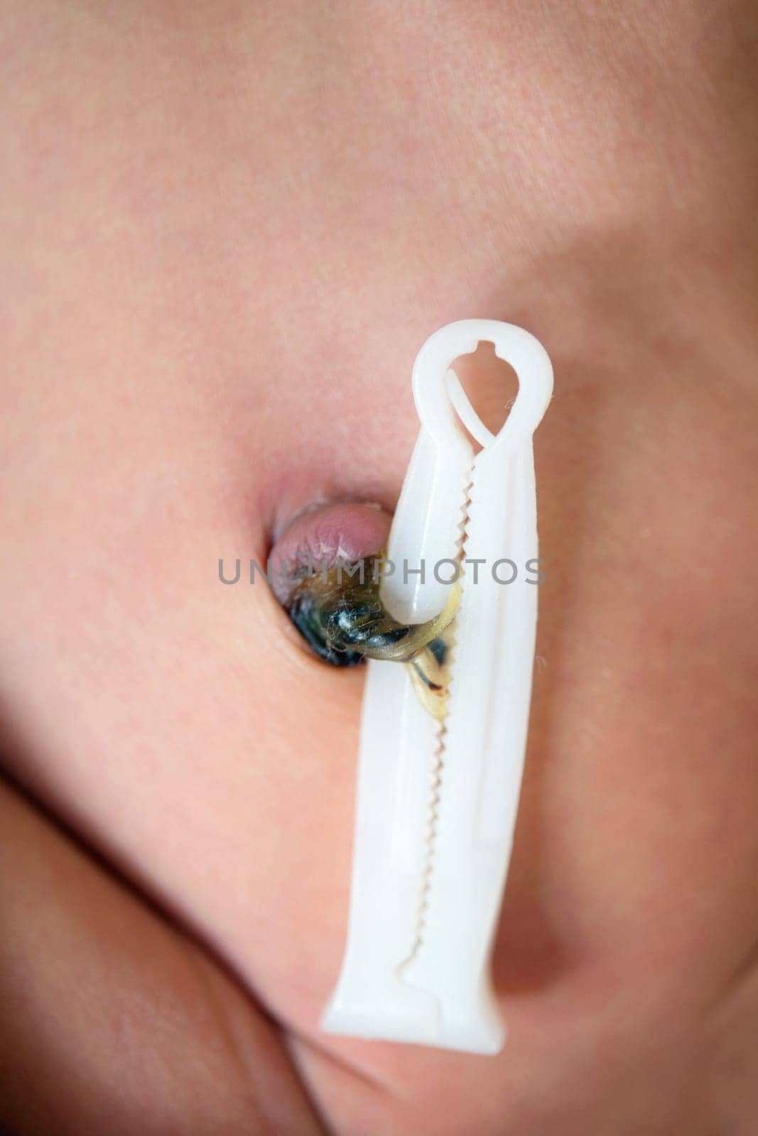 Close up umbilical cord with clamp of 7 days old newborn baby boy.