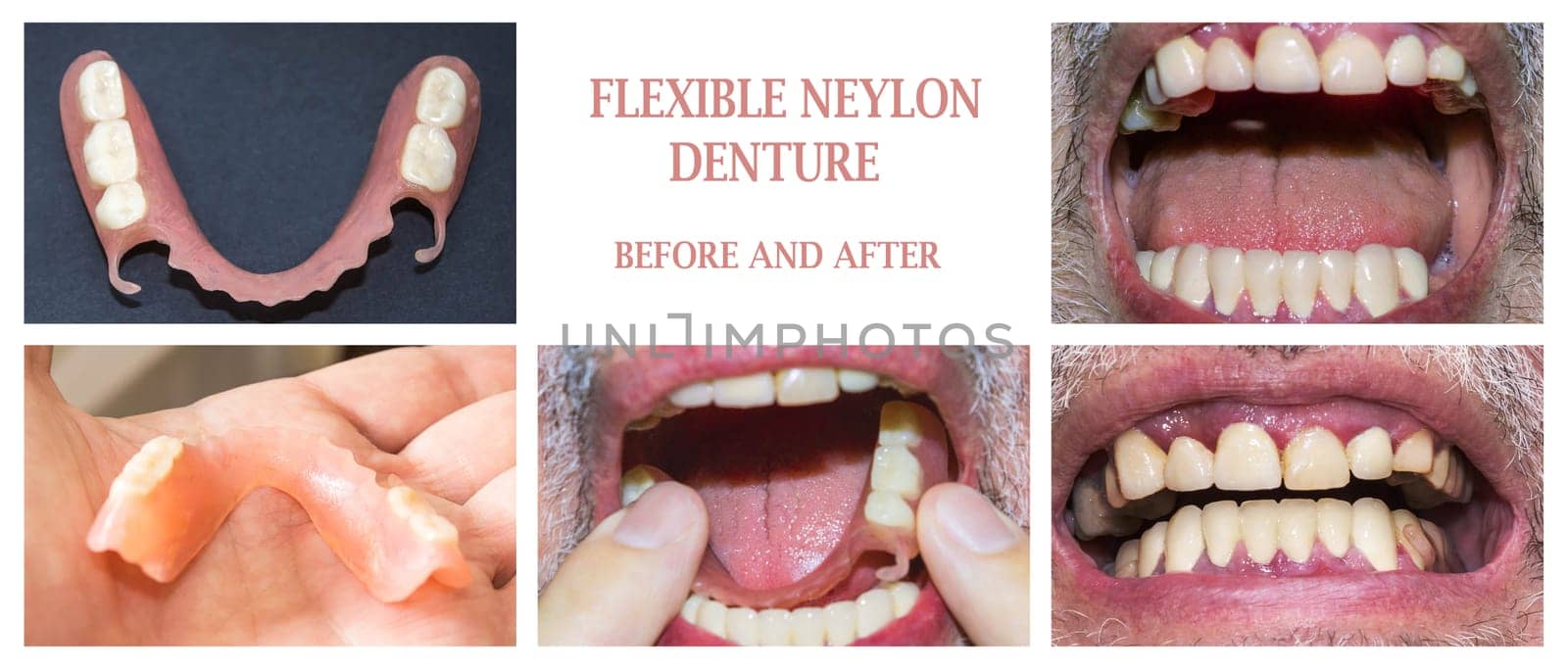 Dental rehabilitation with lower flexible nylon denture, before and after treatment. Removable dentures flexible, devoid of nylon, hypoallergenic exempt from monomer