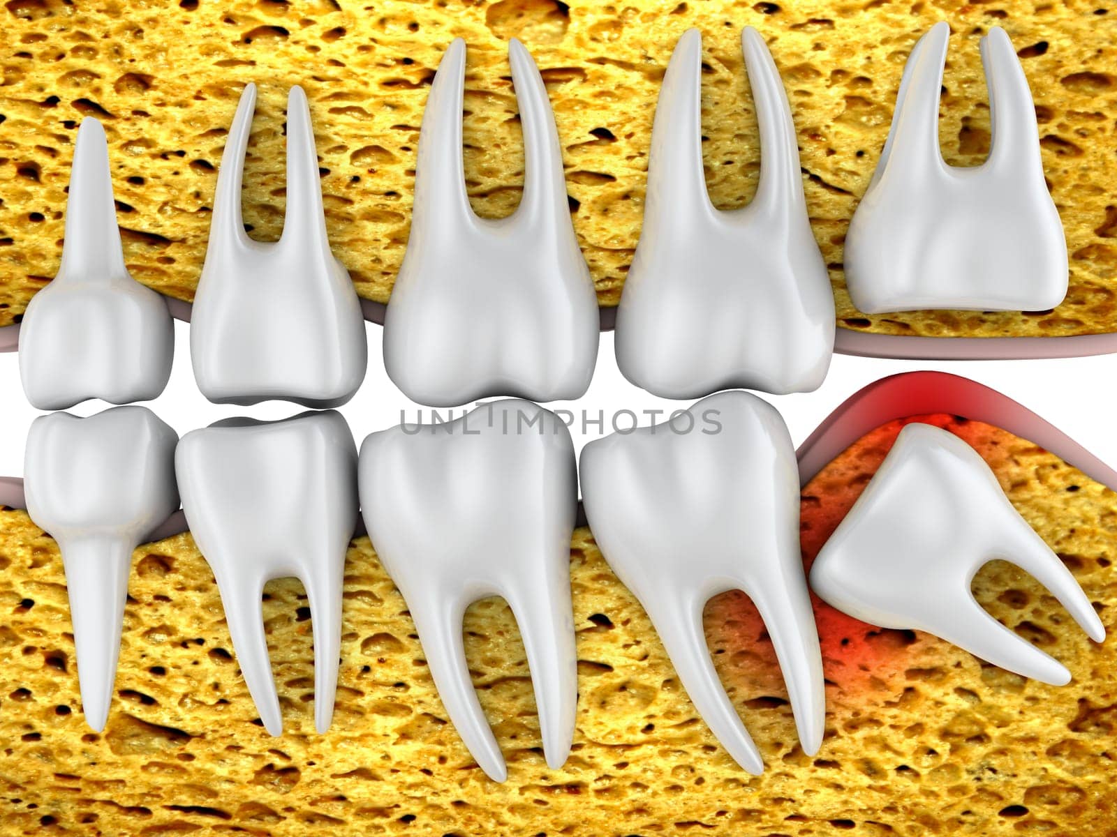 Dental row of molars and an improperly located wisdom tooth. 3d rendering.