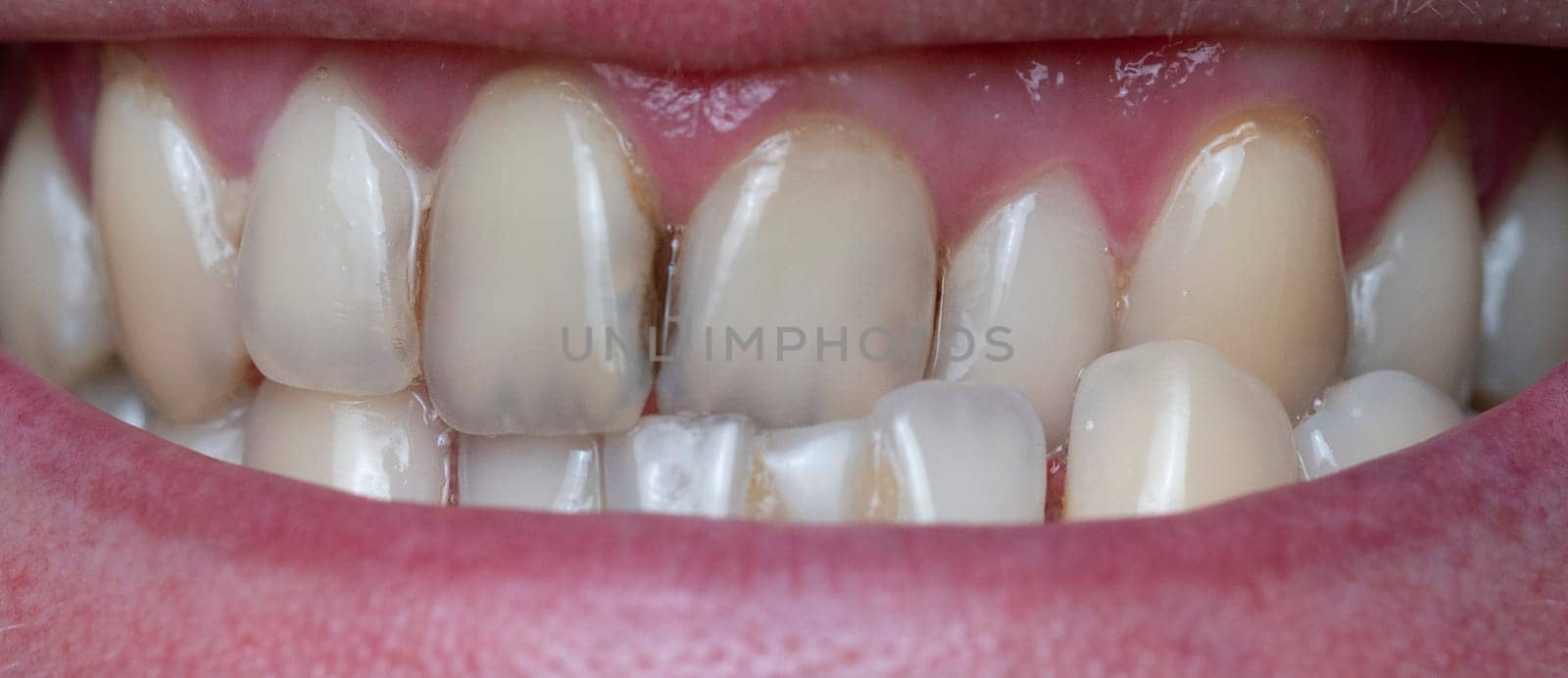 Closeup of dental plaque on man's teeth caused by coffee residual