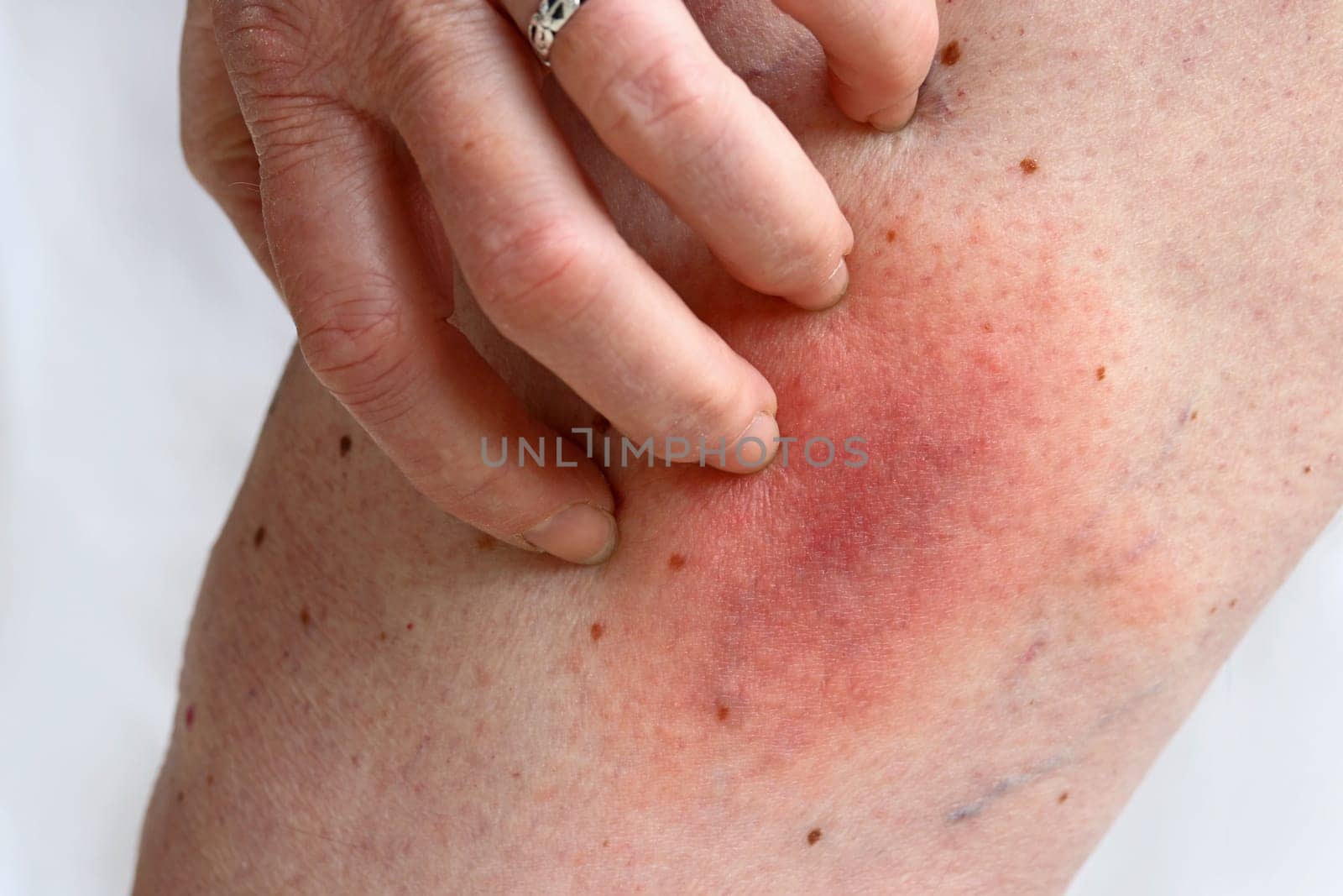 Allergic reaction to a bee sting on a woman's leg. Allergic rash