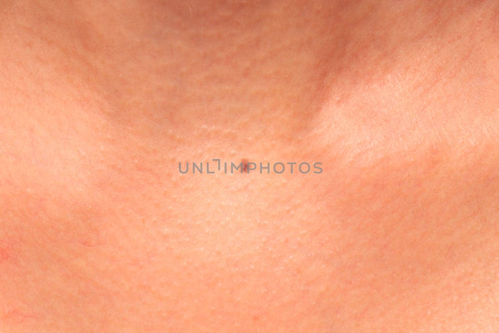 Birthmark between the clavicles under the neck