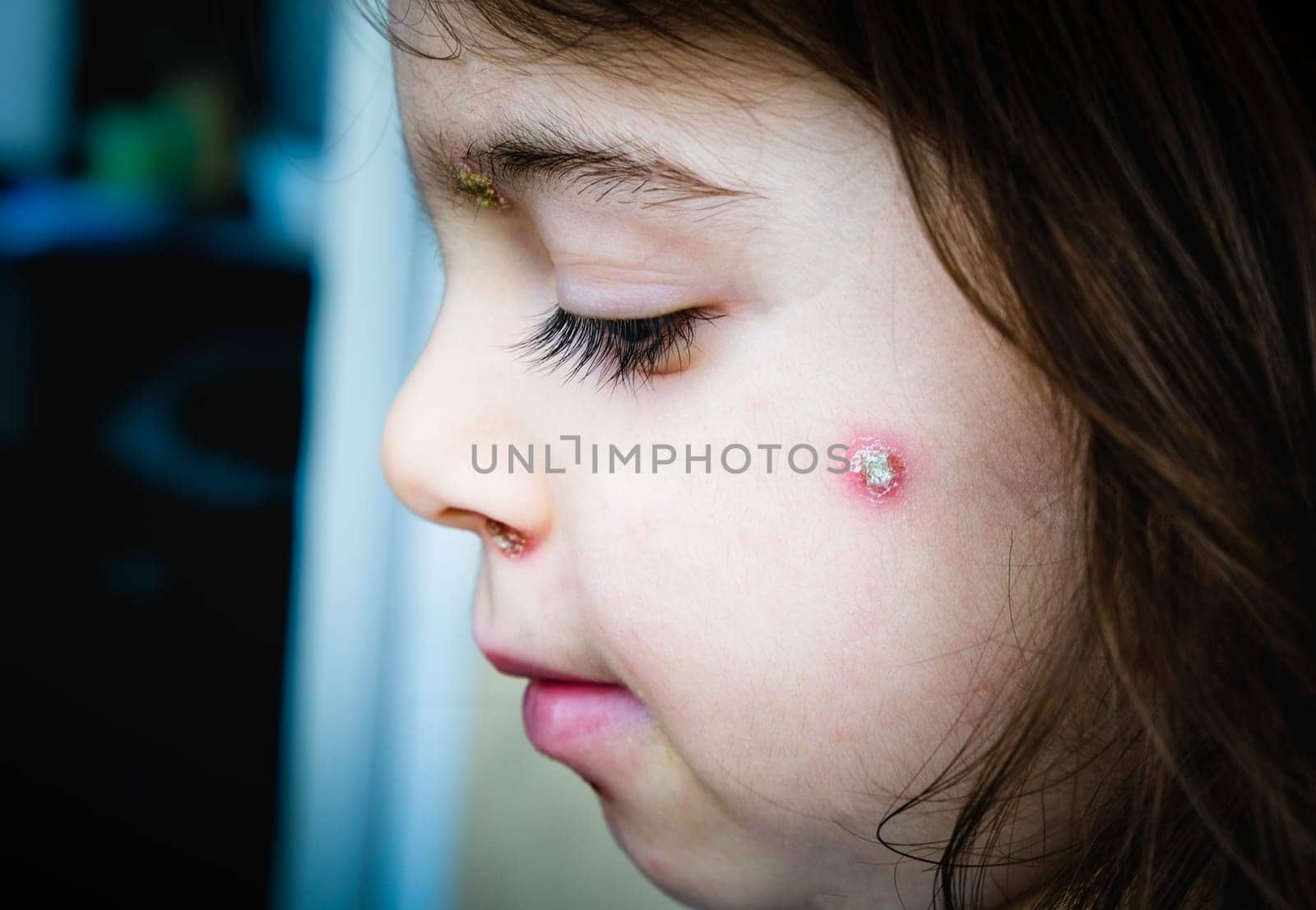 chicken pox spots baby face side cheek