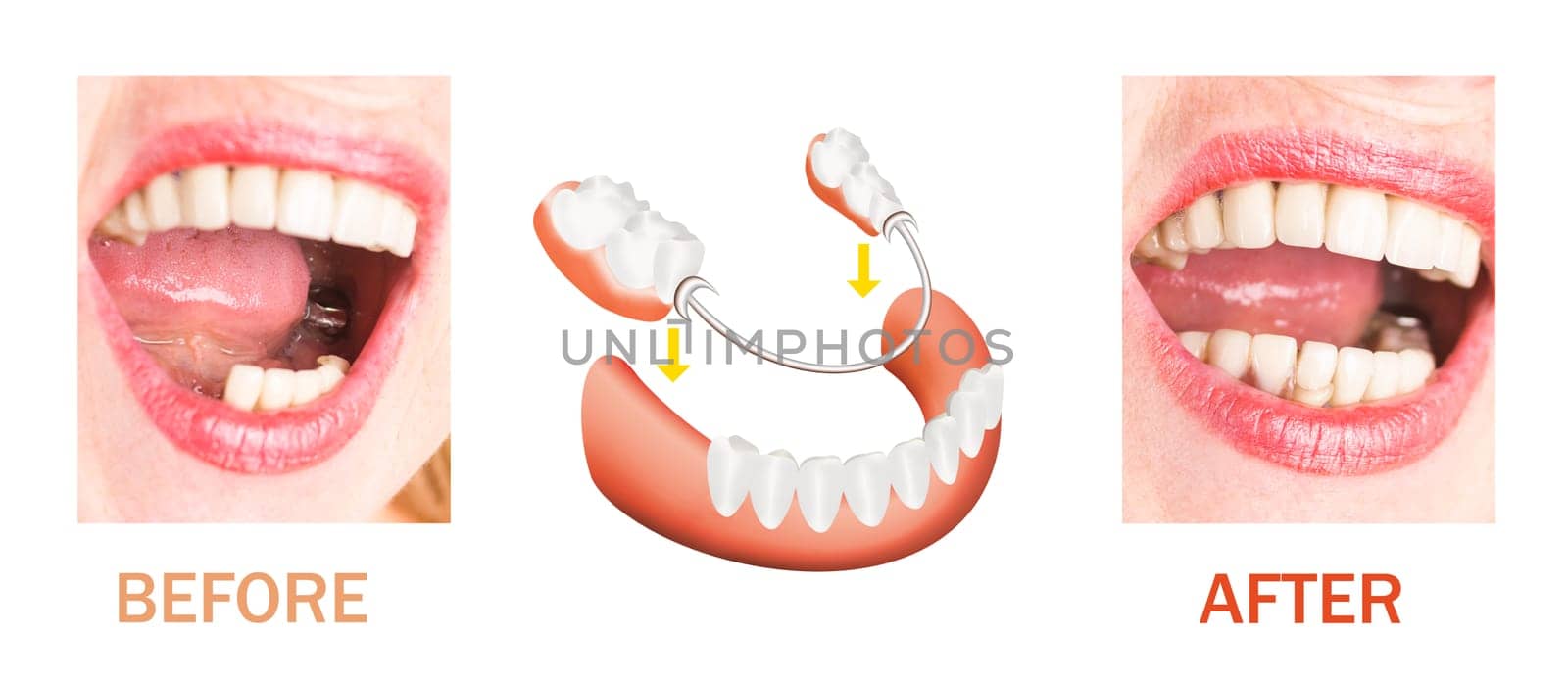 Dental rehabilitation with lower flexible nylon denture, before and after treatment. Removable dentures flexible, devoid of nylon, hypoallergenic exempt from monomer