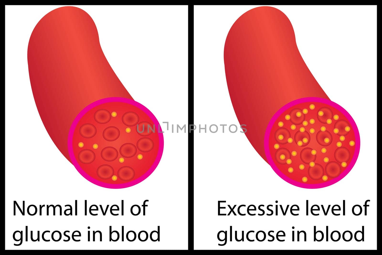Normal and excessive level of blood sugar glucose control vector illustration