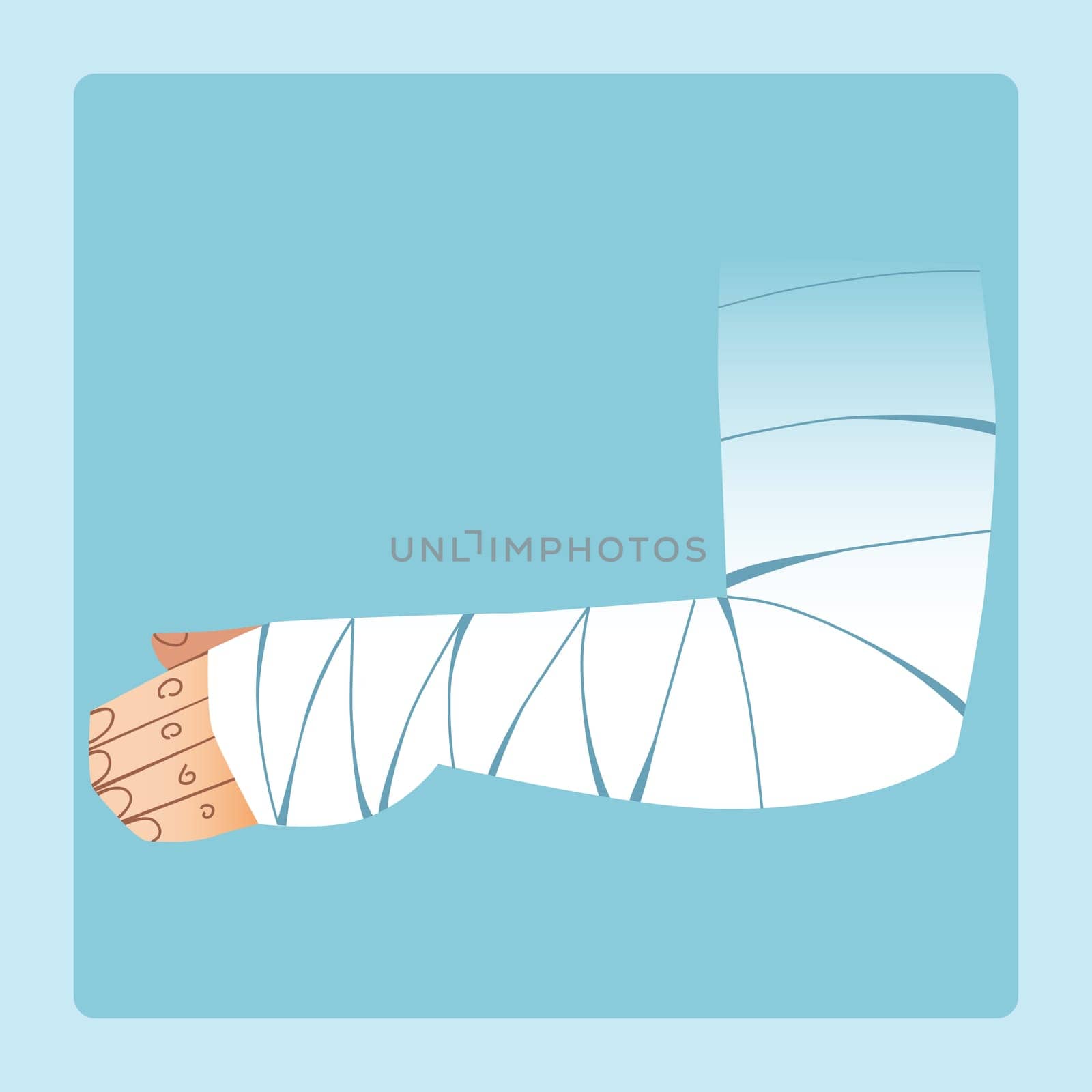 Bandaged hand after fracture or injury. Medicine and health