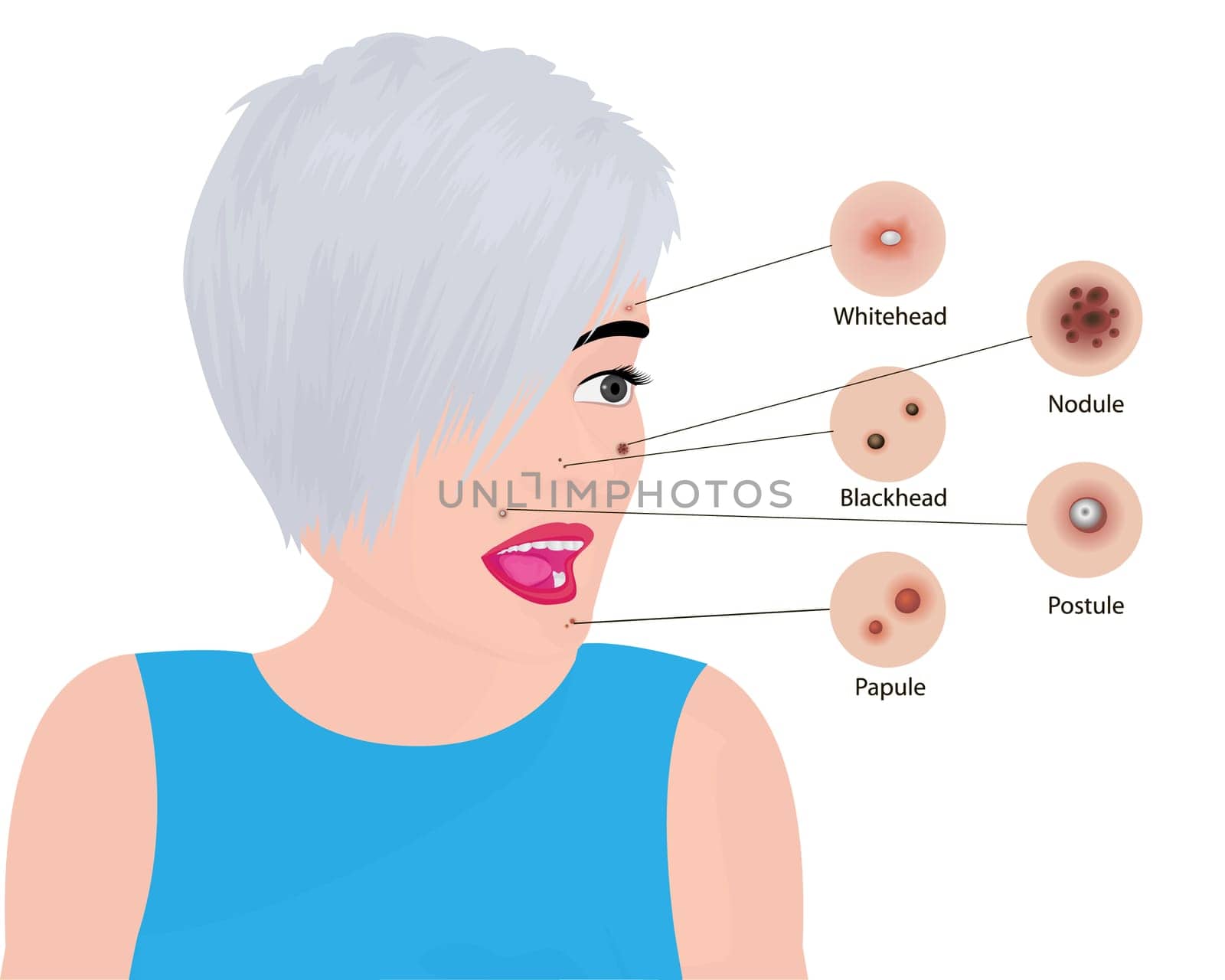 Acne types on a face vector illustration. Cosmetology skincare, skin treatment