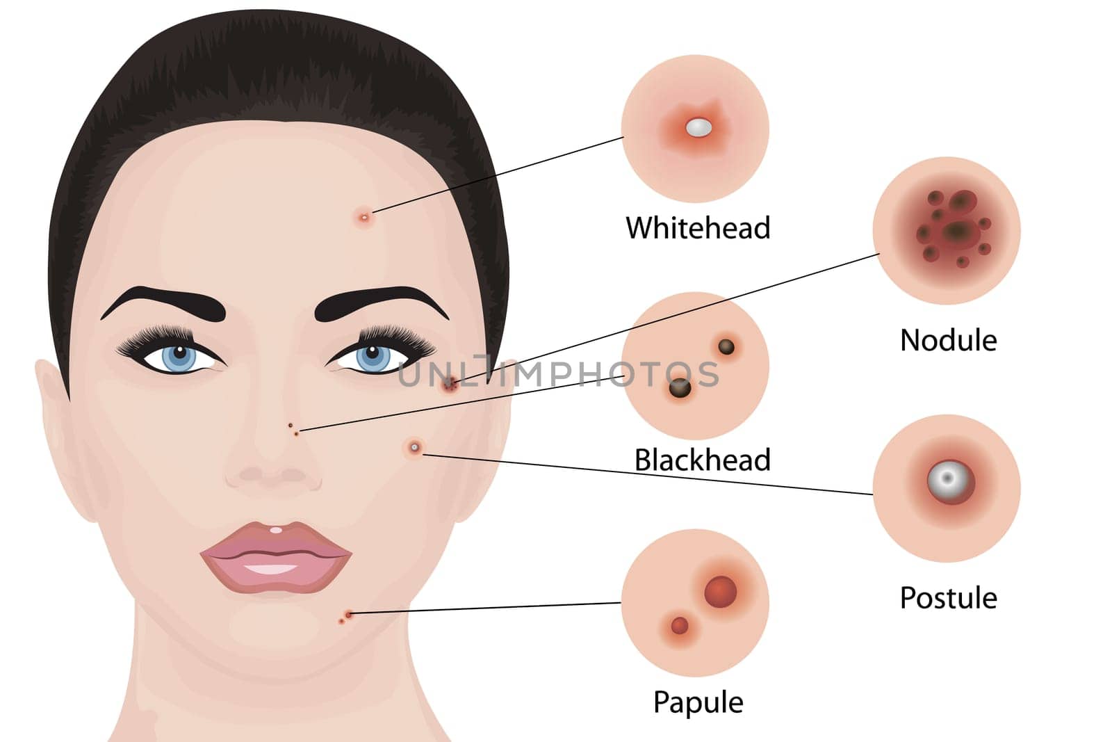 Acne types on a face vector illustration. Cosmetology skincare, skin treatment