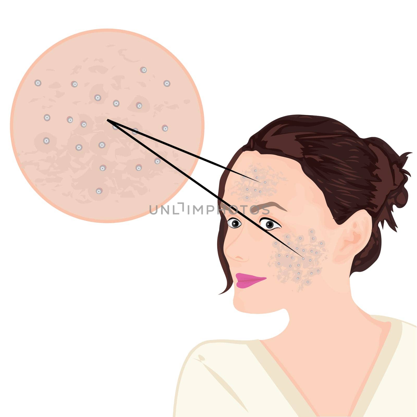 Acne on a face vector illustration showing skin problem