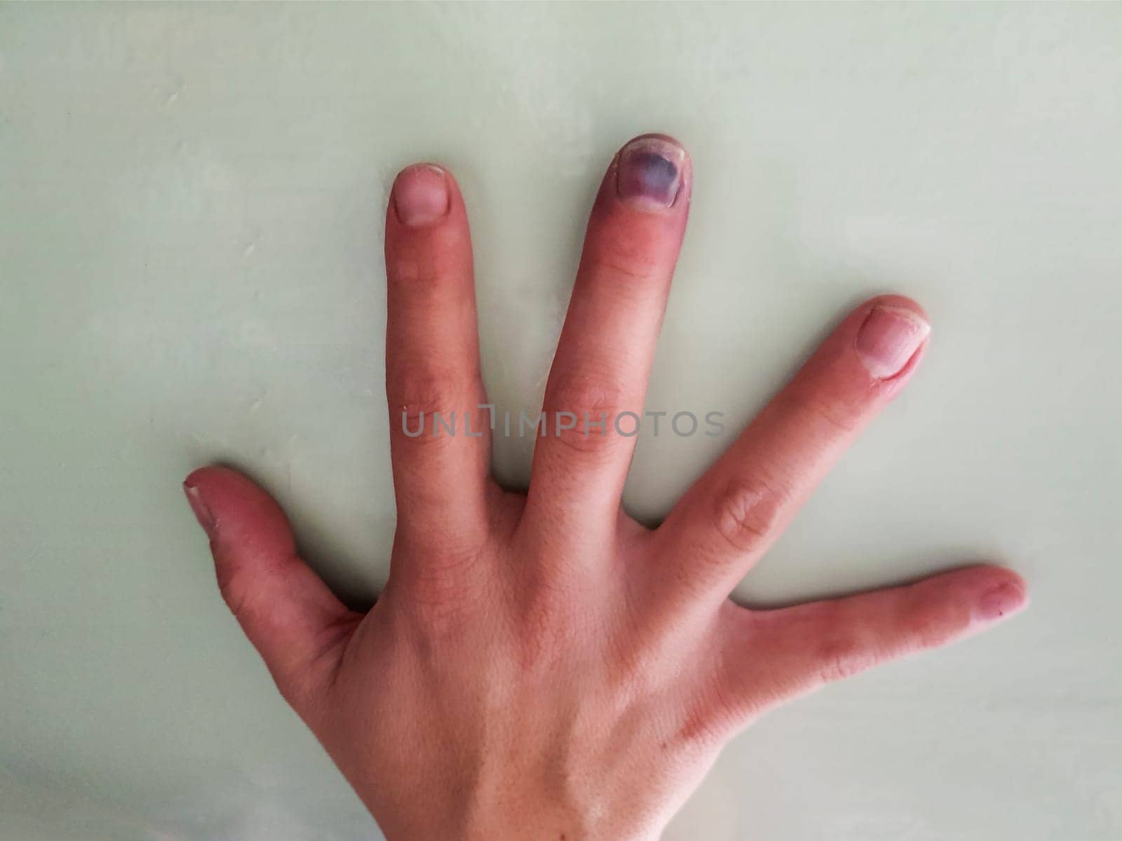 Black injured nail. The middle finger on his right hand was injured. Brused black nail on a finger.