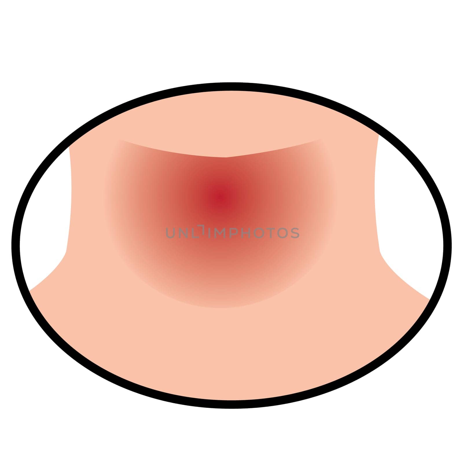 Sore throat because of flu inspiratory infection vector illustration on a white background