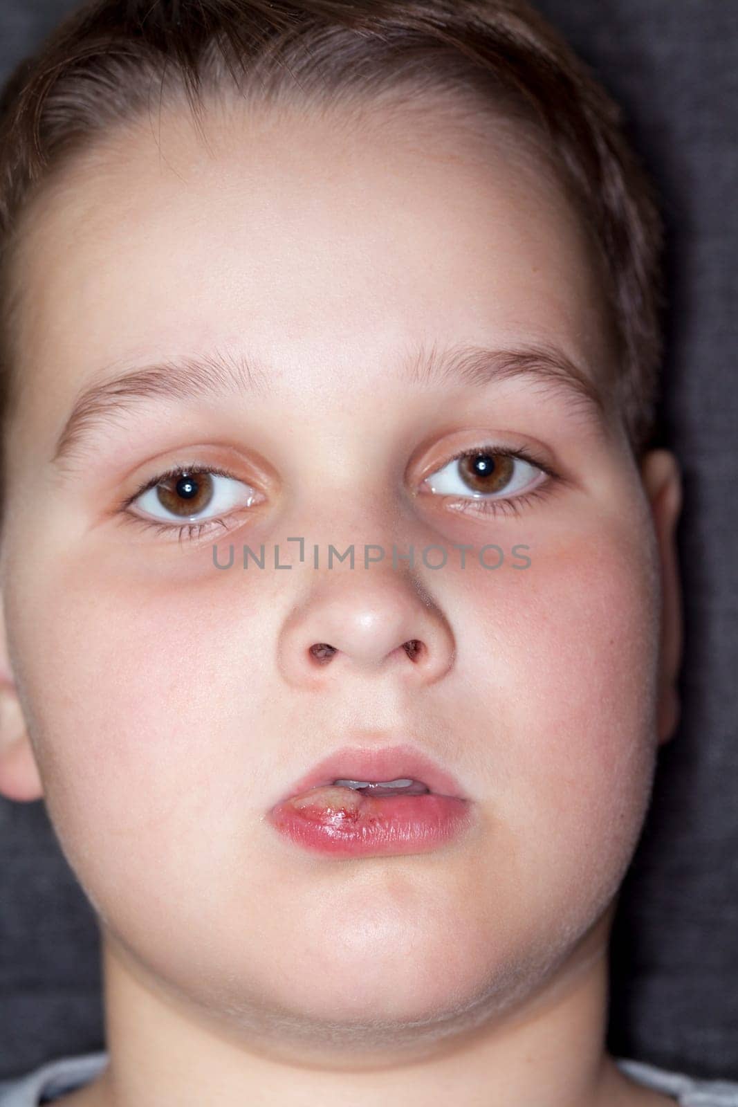 sick boy with big haze on his lips, close photo shot