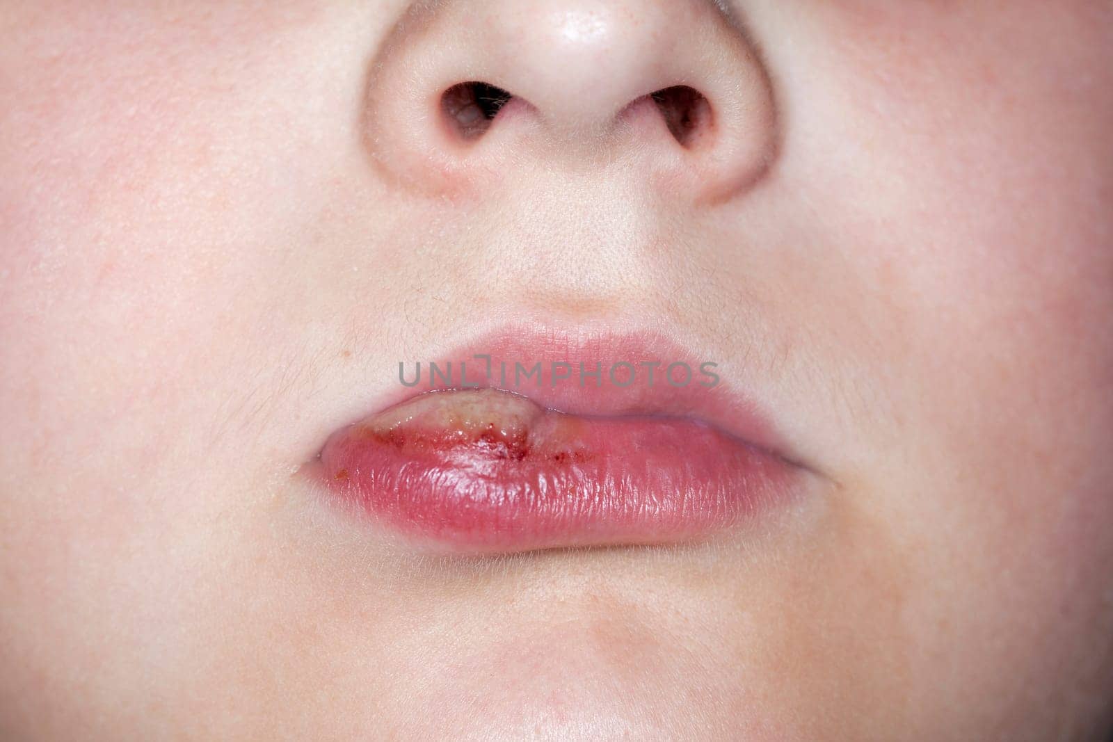 sick boy with big haze on his lips, close photo shot