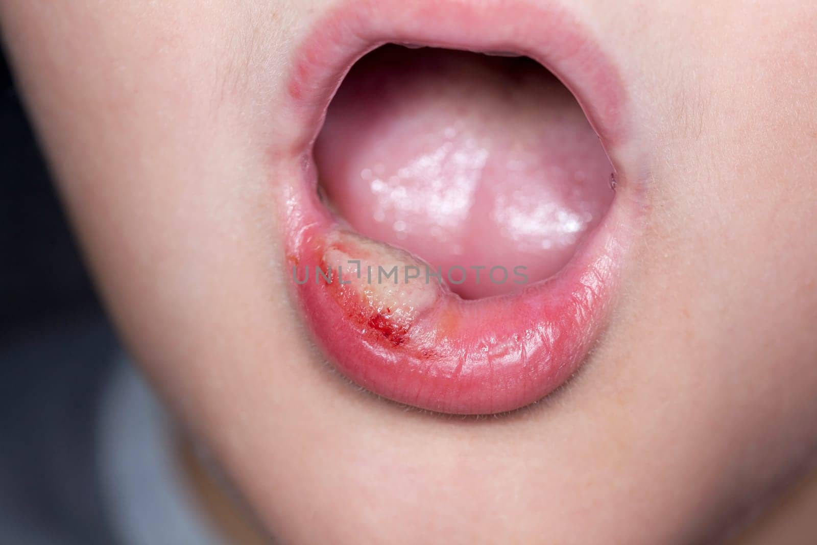 sick boy with big haze on his lips, close photo shot